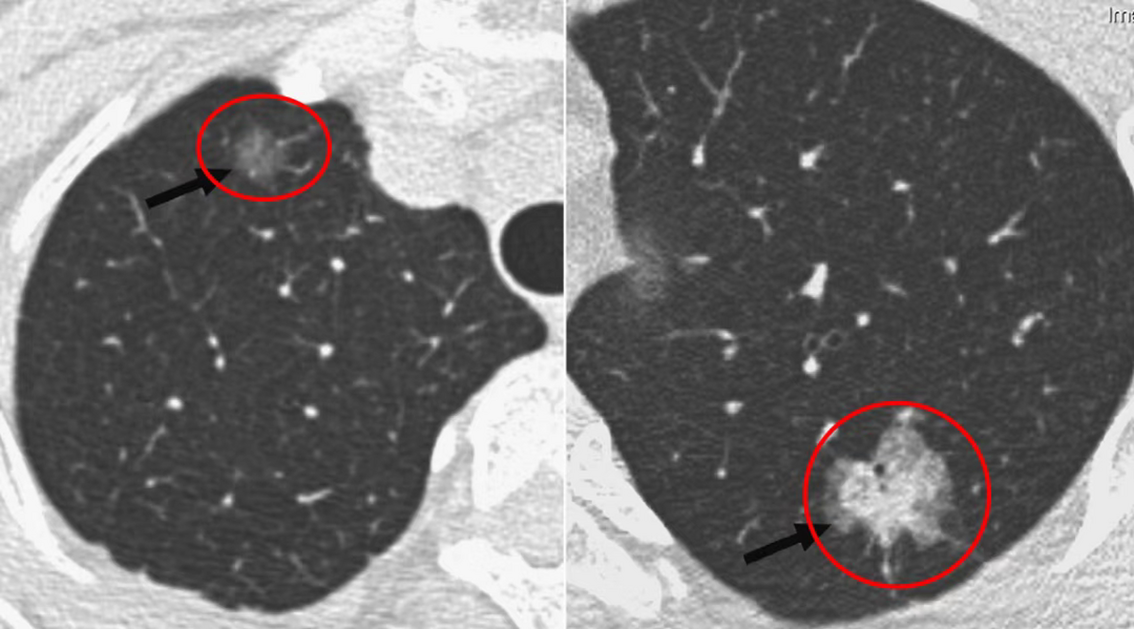 体检查出肺上有磨玻璃结节, 一定要手术切除吗?  大家好!
