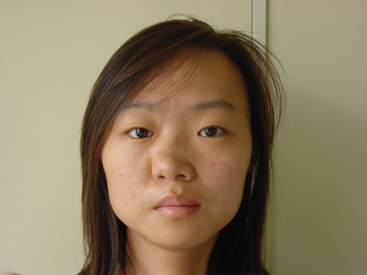 图中这位姑娘是我前几年修复的一位歪鼻患者,可以看出她的鼻子"扭曲"