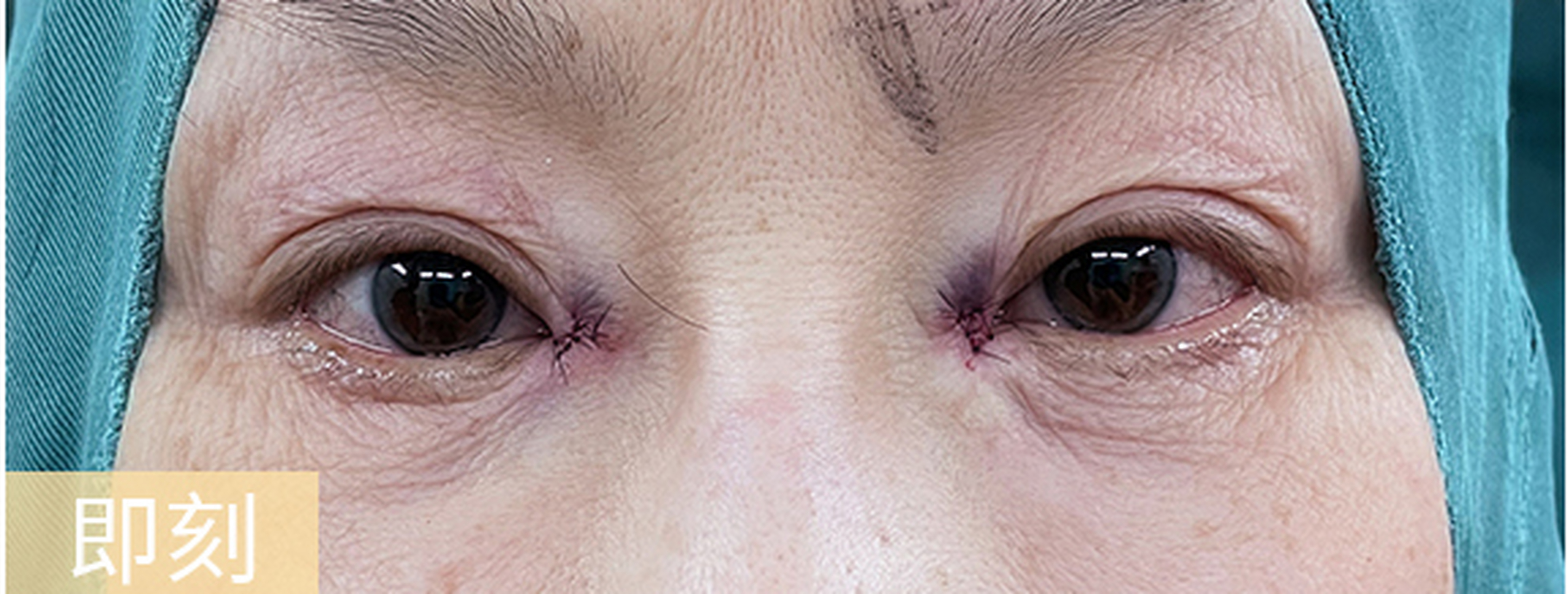 很多人开眼角后效果不满意,可以考虑内眼角回包.