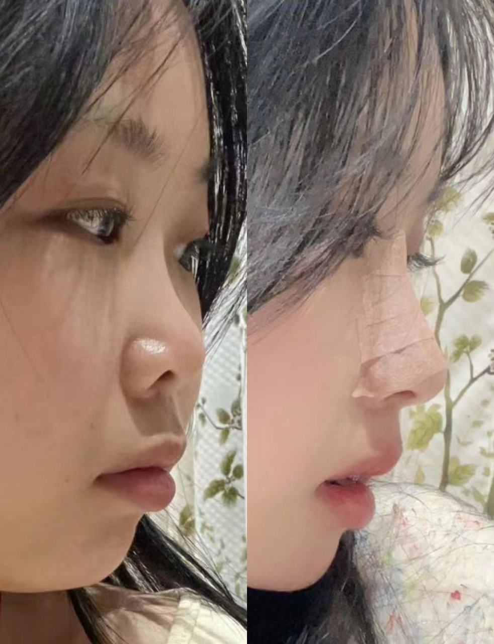 朝天鼻手术前后对比  朝天鼻手术是一种用于改善鼻部外形的手术,旨在