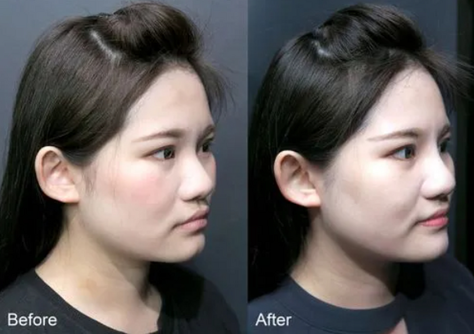 玻尿酸隆鼻后山根变宽,摸起来有残留怎么办?