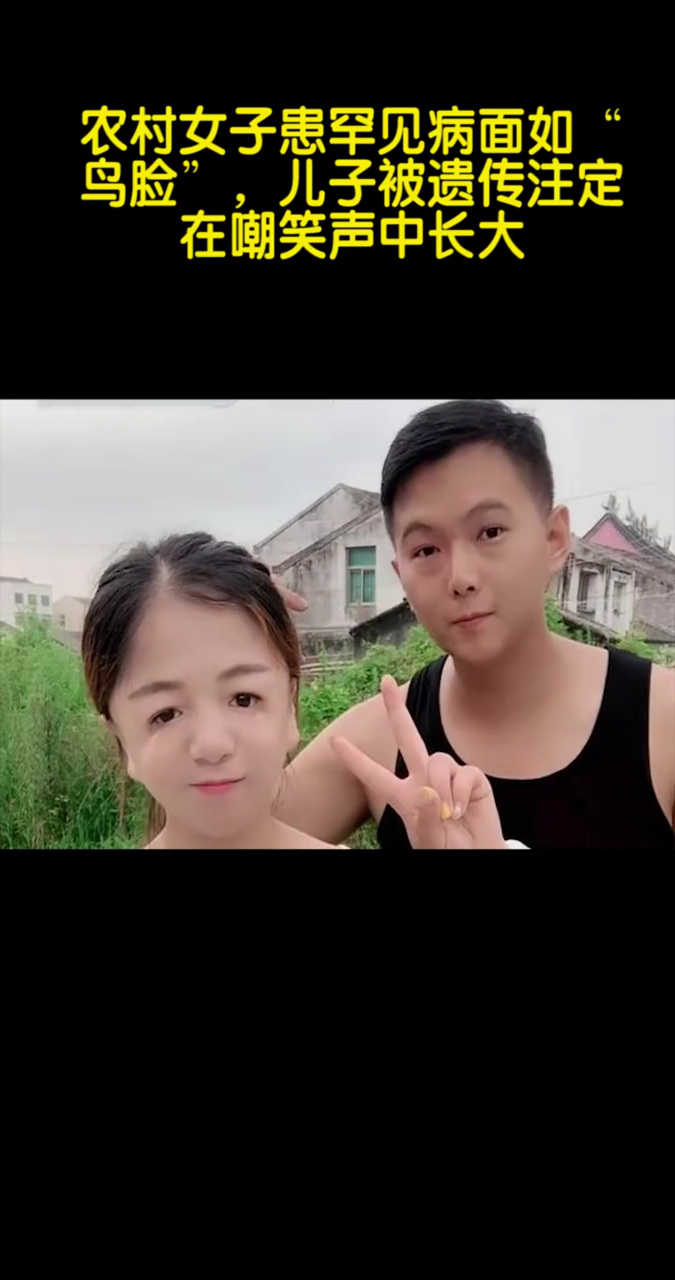 农村女子患罕见病面如"鸟脸",儿子被遗传注定在嘲笑声中长大
