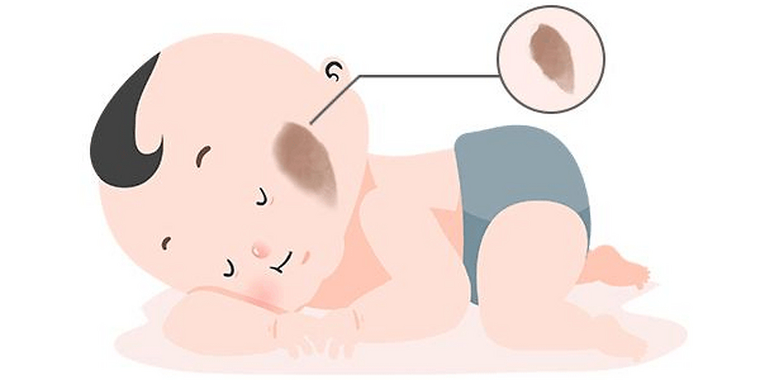 去胎记# 相信屏幕前的有些胎记患者在治疗的过程中常常会发出这样的