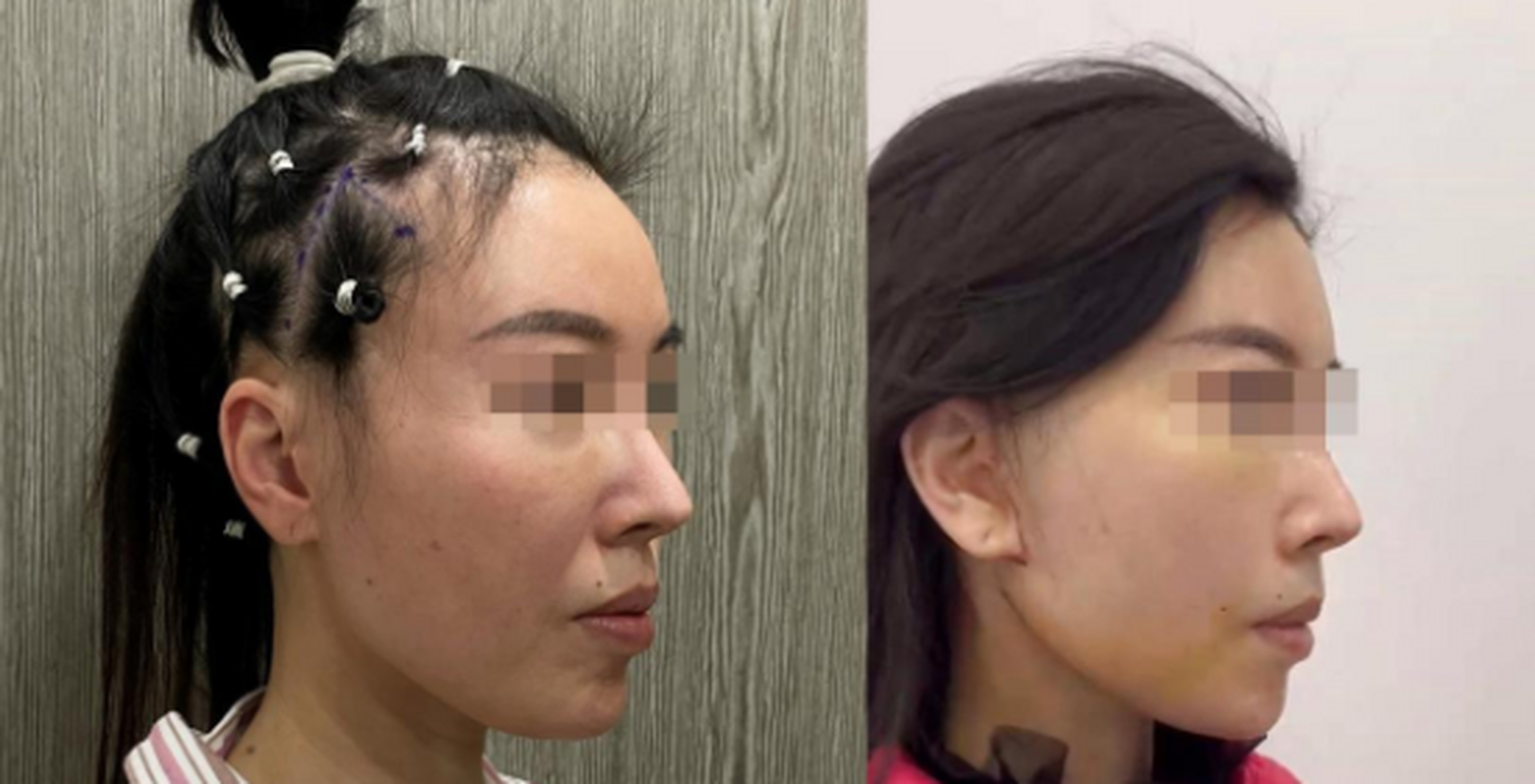 给大家看个案例,#拉皮手术# 前后对比,你们觉得变化大吗?#拉皮