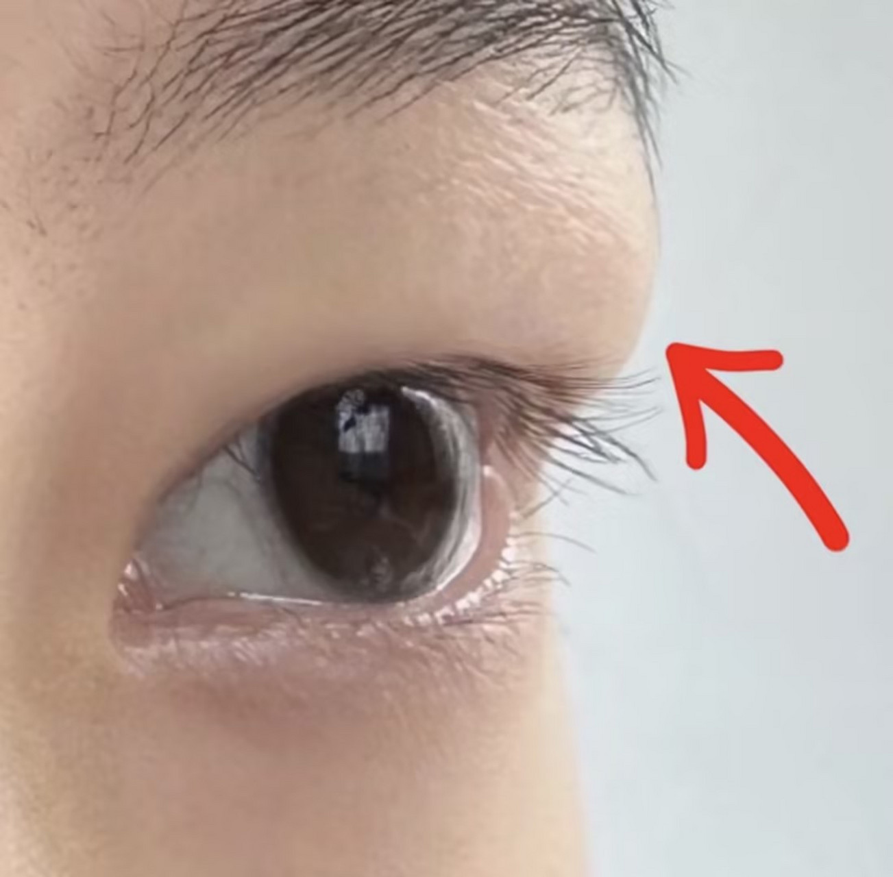 造成肿眼泡的原因主要有以下3点:  眶隔内脂肪脱垂造成: 眶隔内脂肪