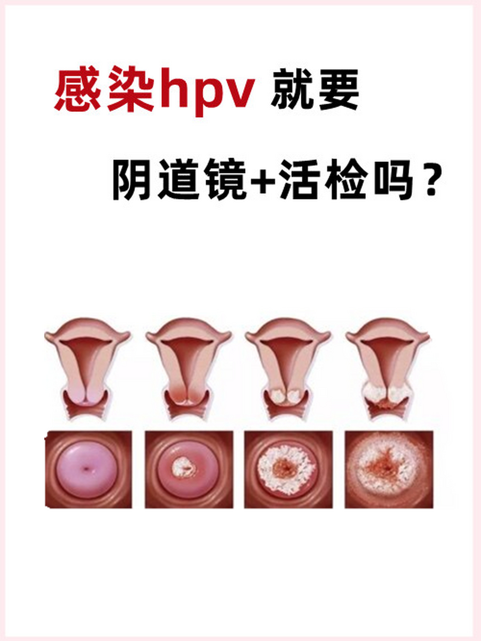 hpv感染一定要做y道镜 活检吗?