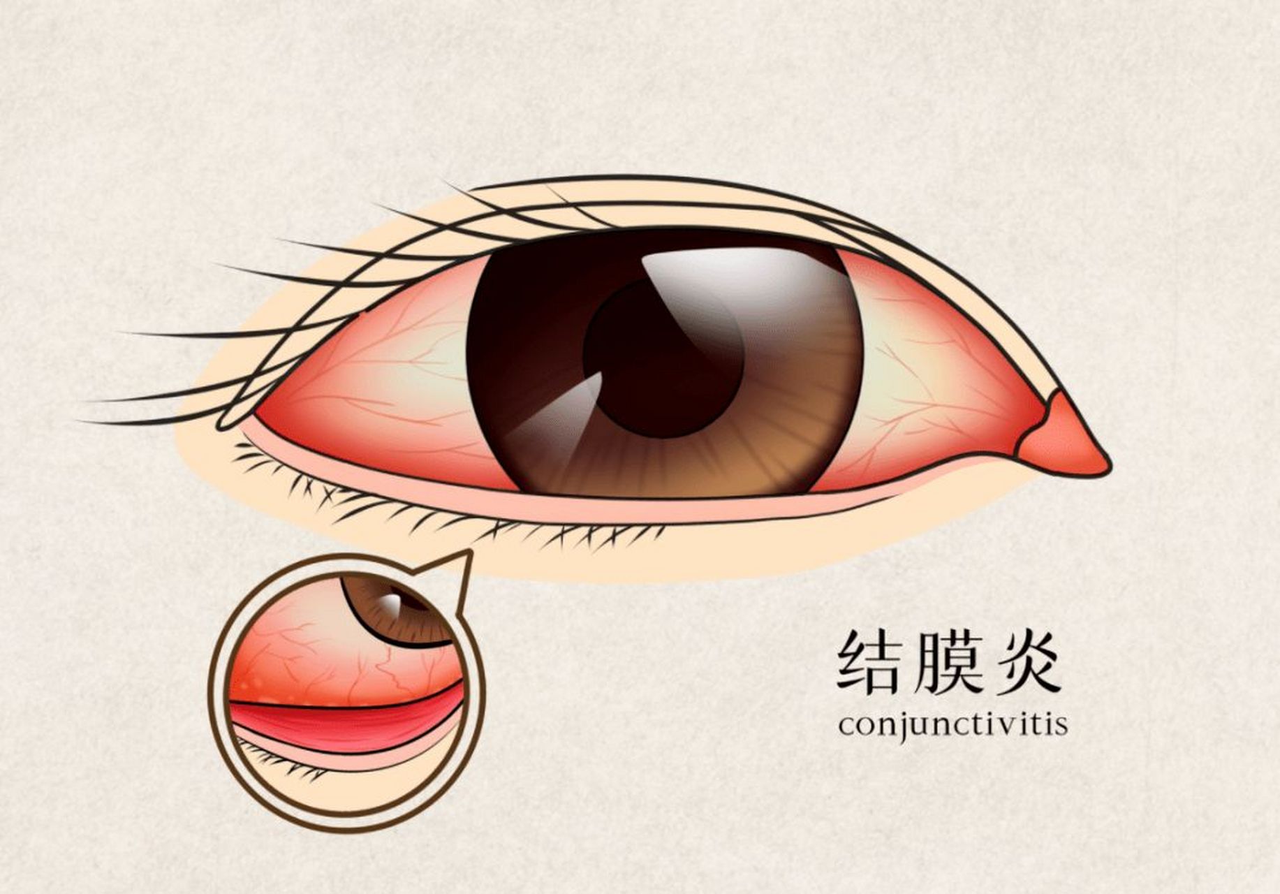 过敏性结膜炎不好治?