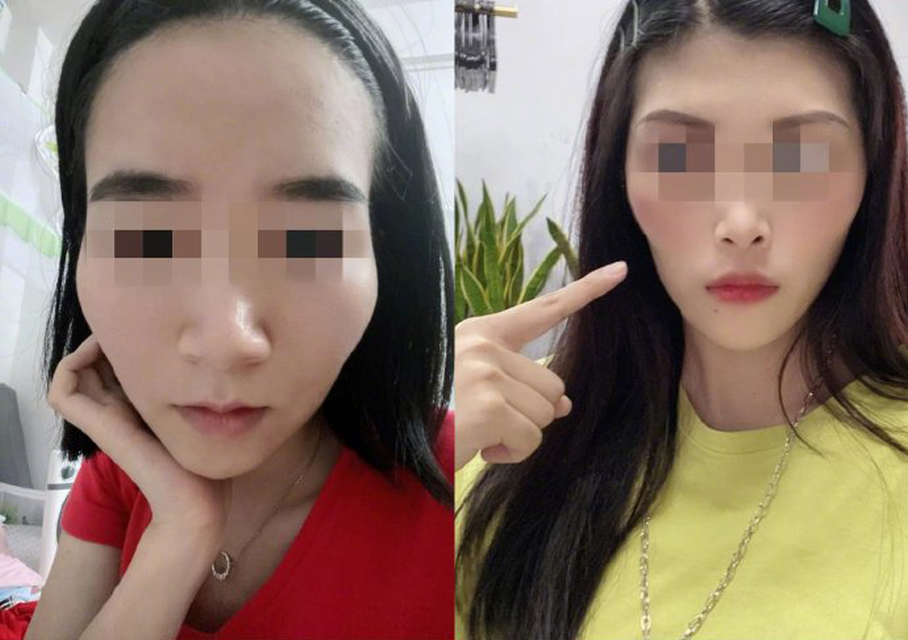 摘牙套一年,太阳穴凹,脸颊凹,颧骨高,要怎么改善?