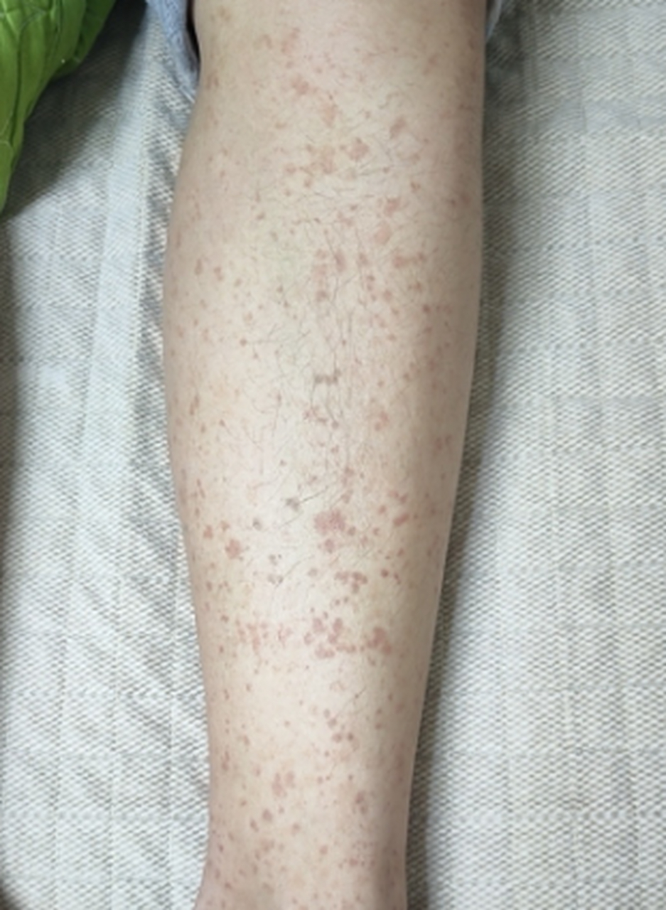 大家好,我是血液科肖医生[爱你]~紫癜是否一定有血小板减少?