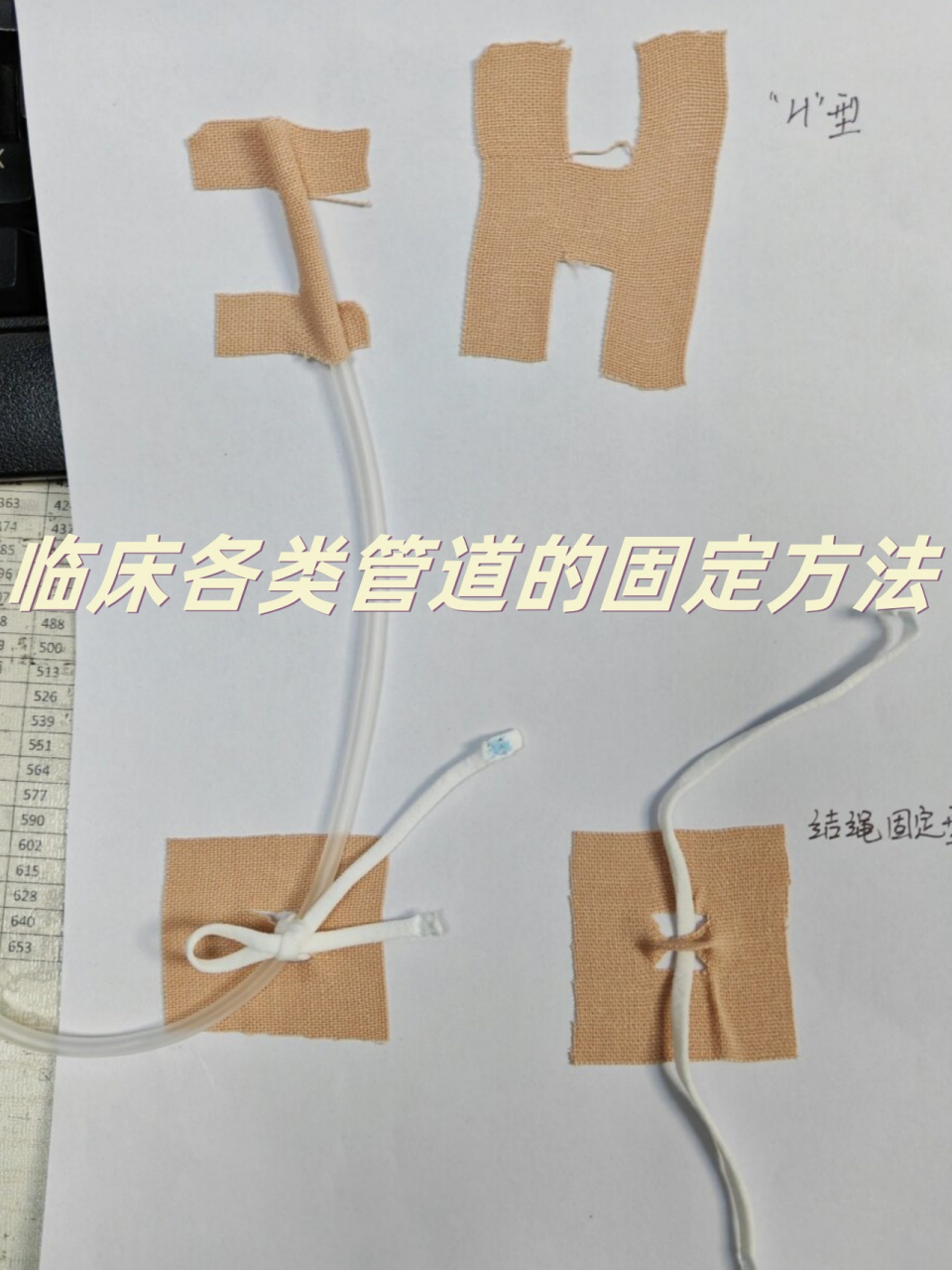 气管插管的固定方法图片