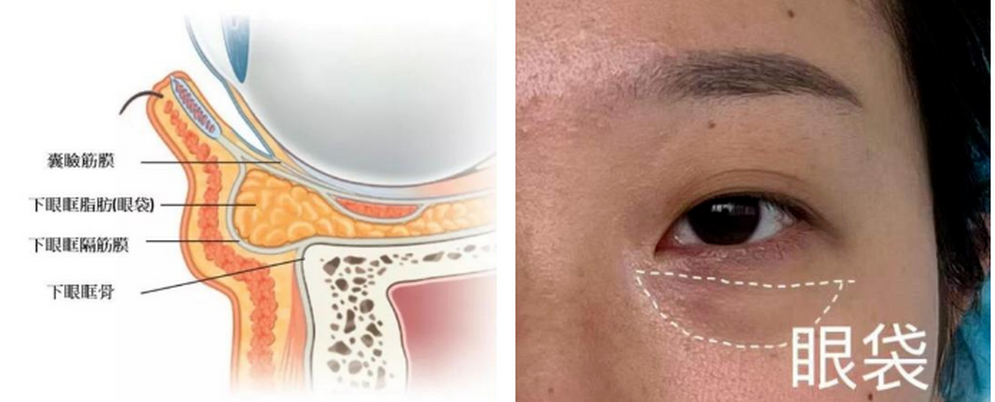 眼部的衰老并不是只有眼袋,眼袋形成主要原因是包绕眶隔脂肪的眶隔膜