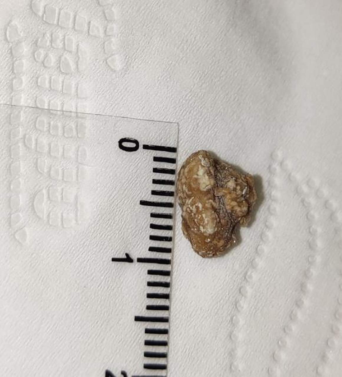 一般肾结石直径 0.6cm时,大约85%的结石可以自行排出体外.