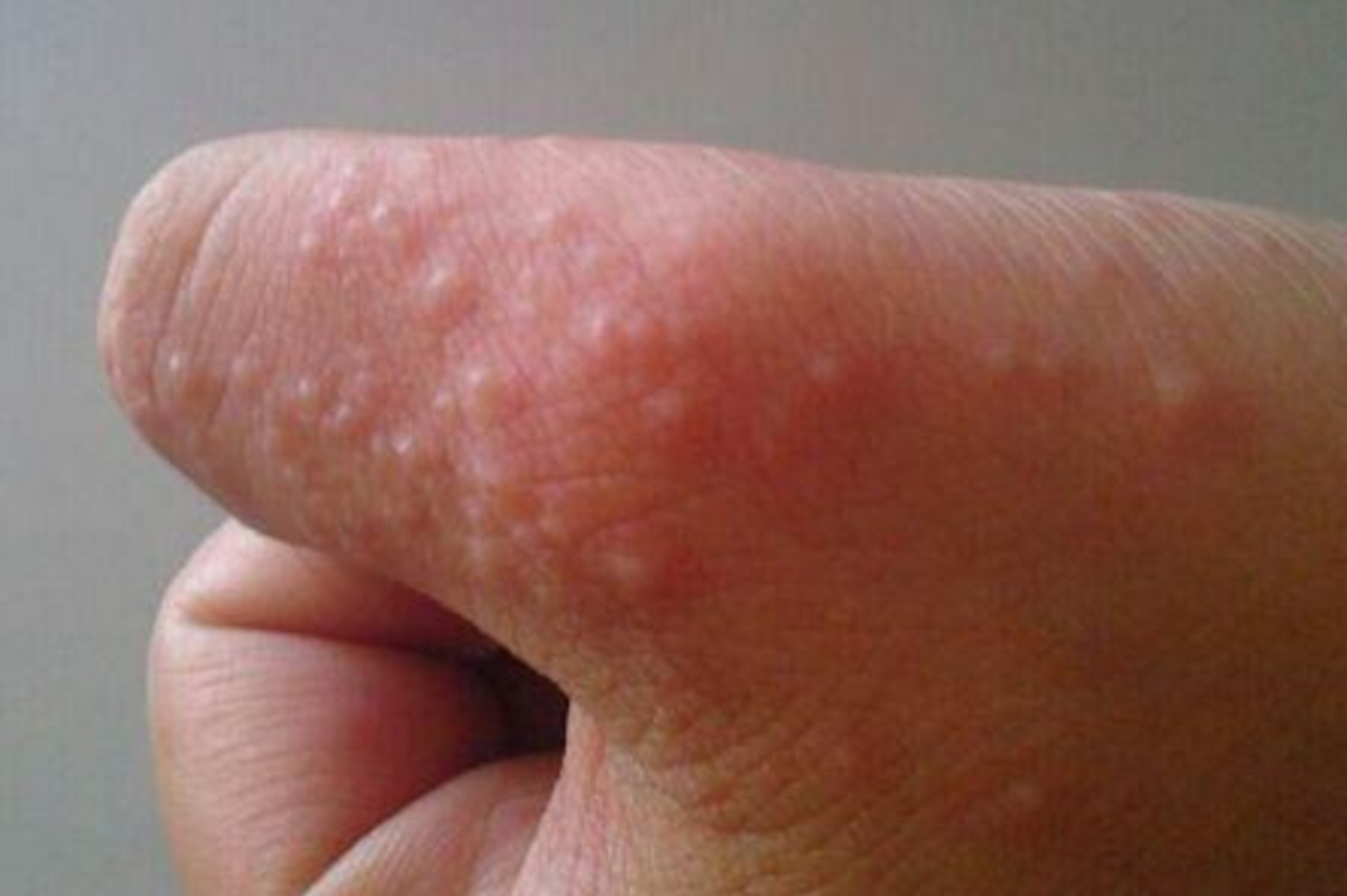 手上长这种透明"小水泡",以为是上火?