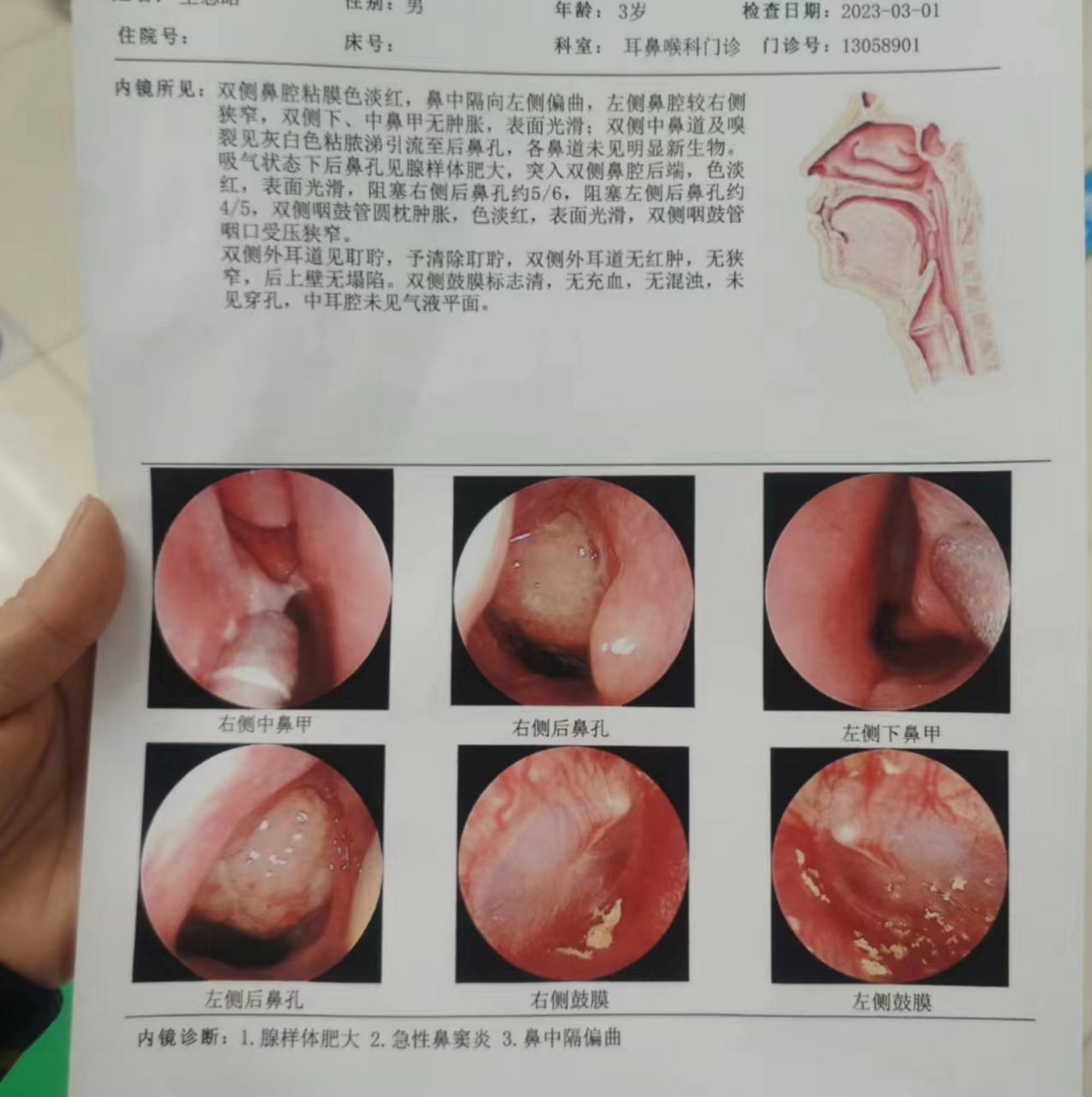 腺样体肥大不用切除也能好,你还不知道吗?