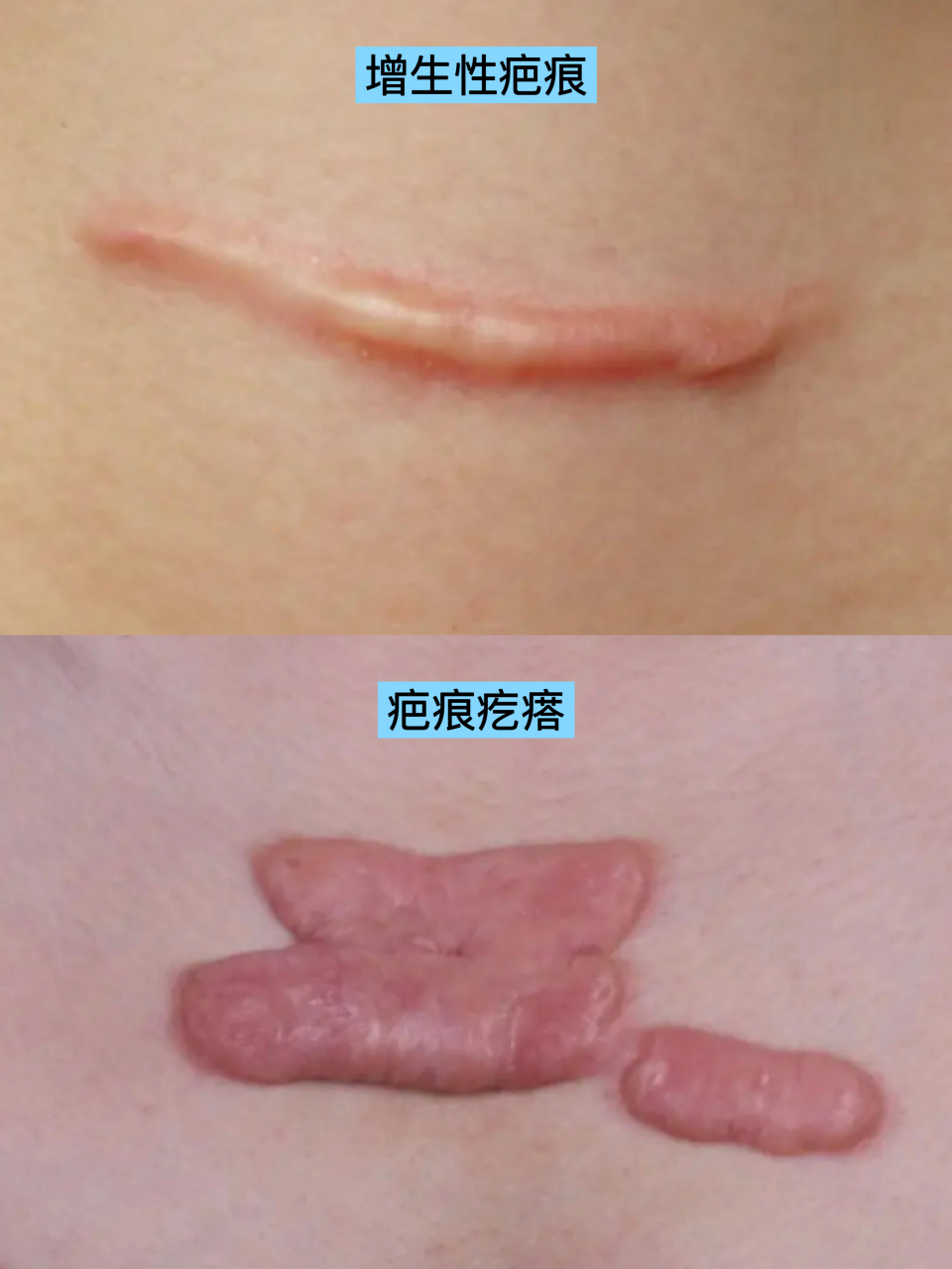 疤痕增生
