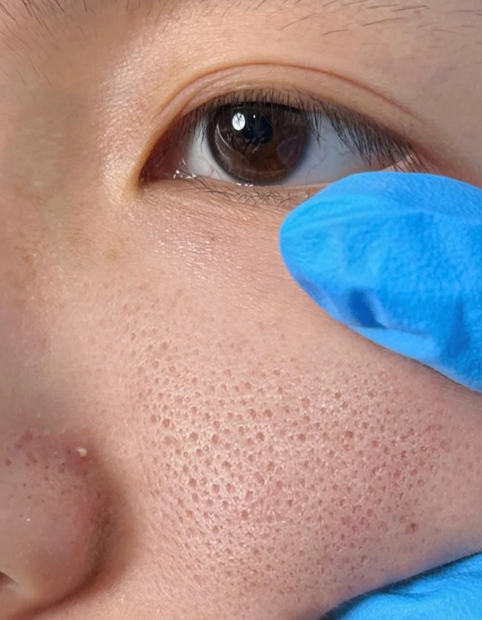 毛孔粗大是许多人面临的共同问题之一,而刷酸作为一种常见的护肤方法