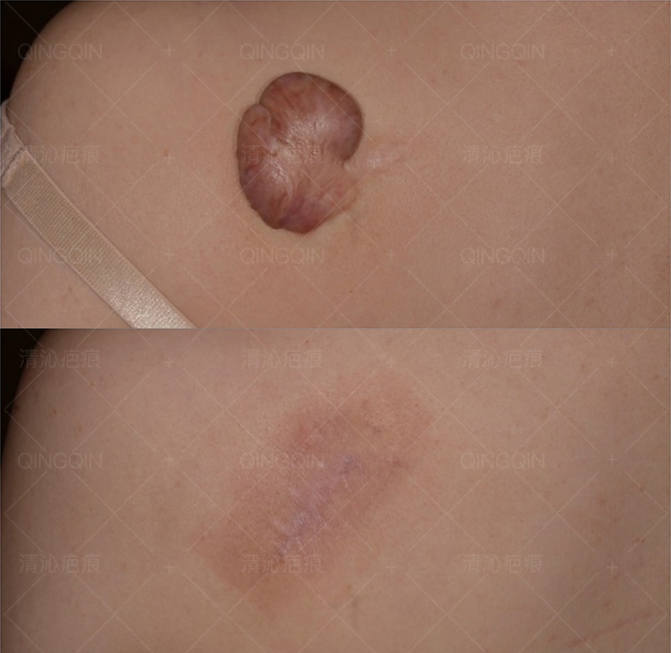 表浅性瘢痕多数采用光电治疗干预为主的治疗手段; 2