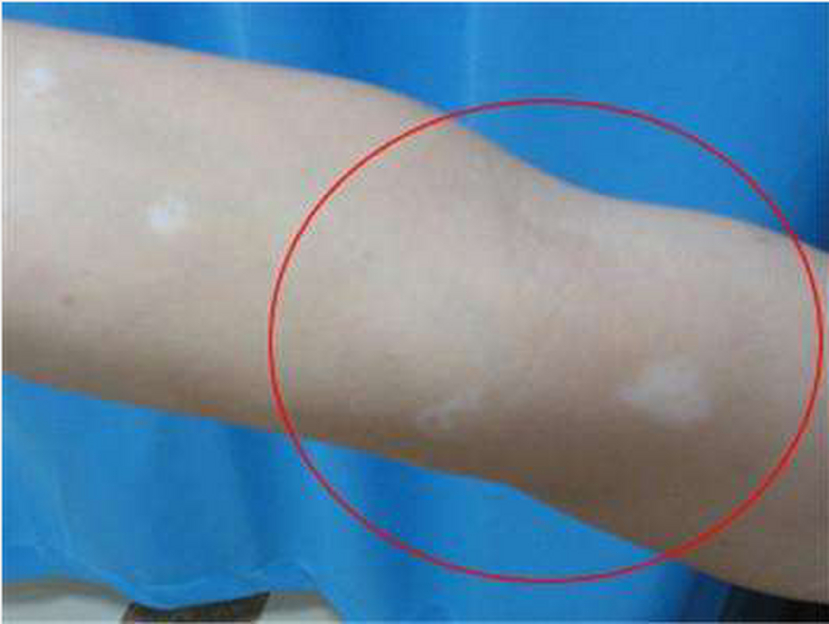 掌握3个鉴别要点  身上长白斑,除了可能是白癜风外,花斑癣,白色糠疹