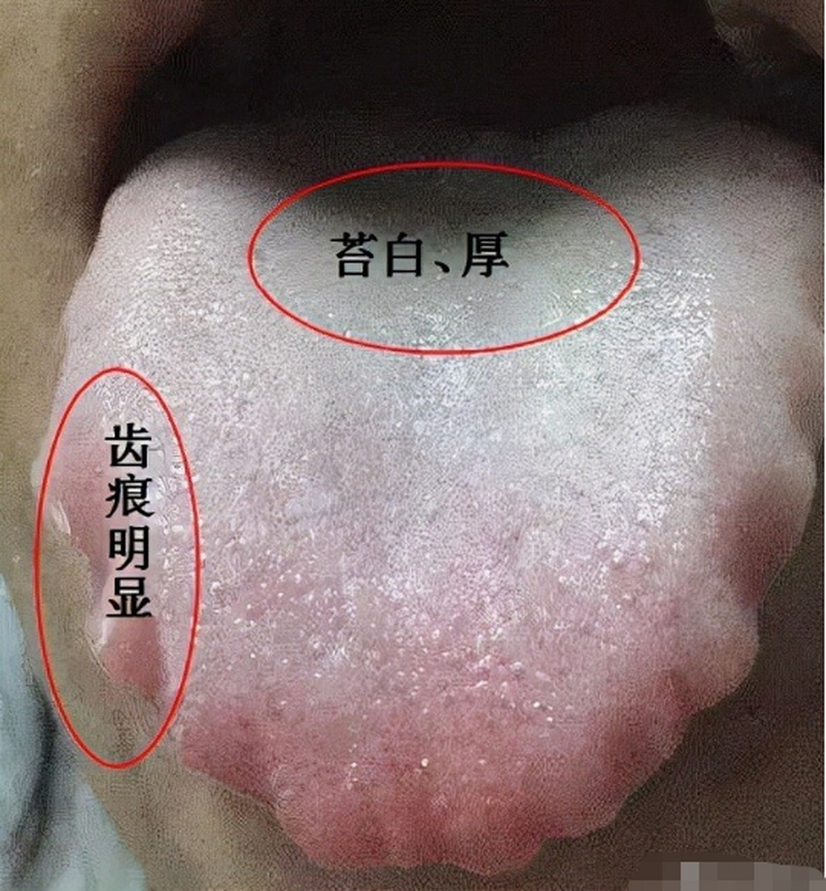 答:在排除一些非病理性,如遗传等,中医多认为齿痕舌多见为脾虚湿盛