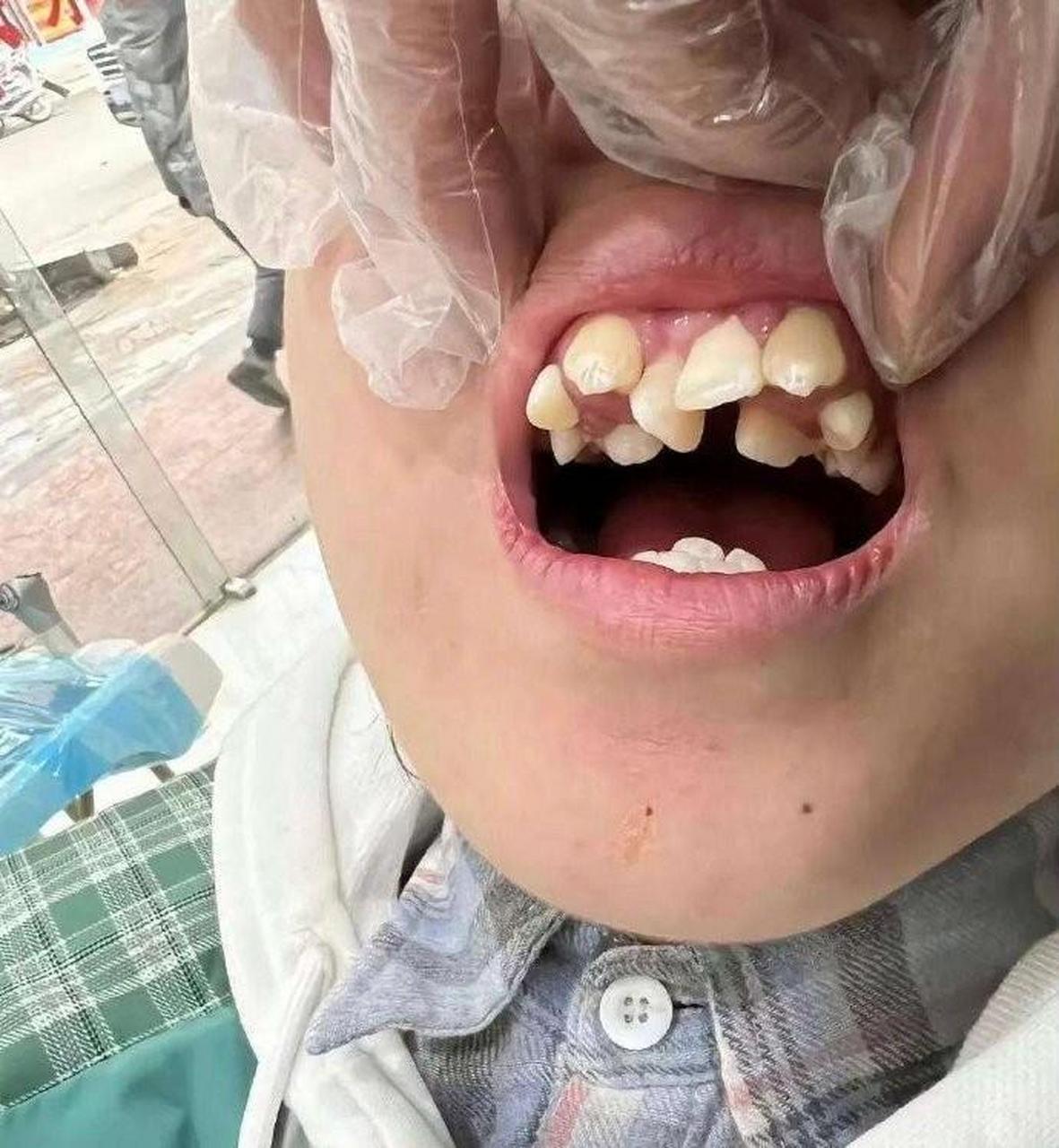 大概需要多少钱 手术难度大不大 这种是多齿症吧