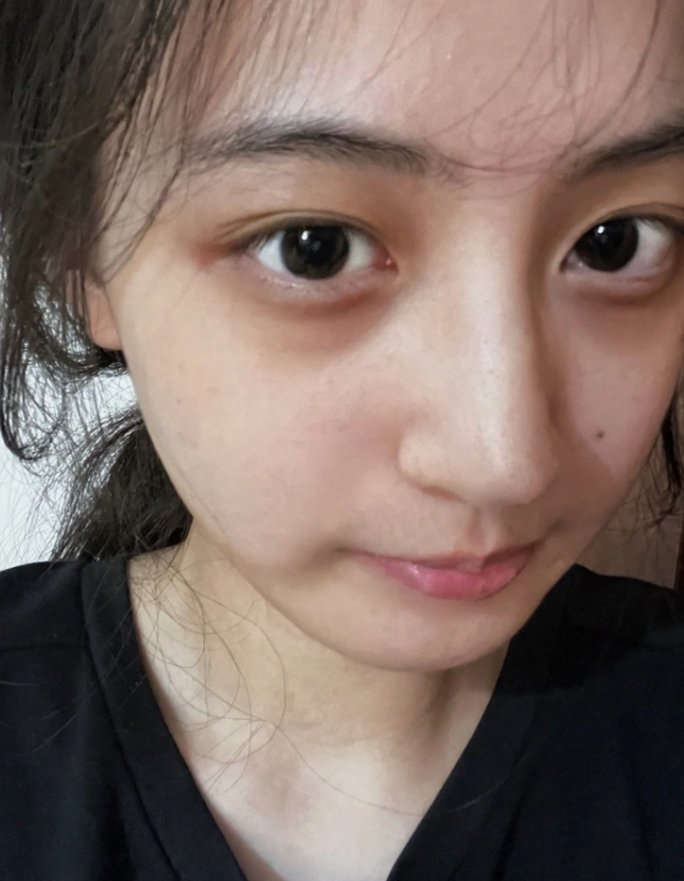 黑眼圈怎么改善 #医美科普挑战赛#