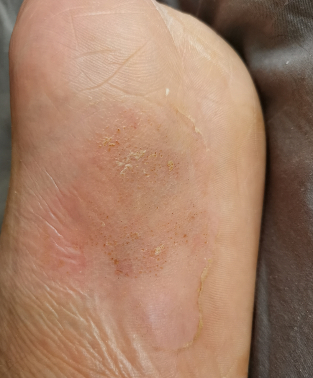 非常病例#  门诊一小伙子脚心长了湿疹,一热就奇痒难忍,影响他正常