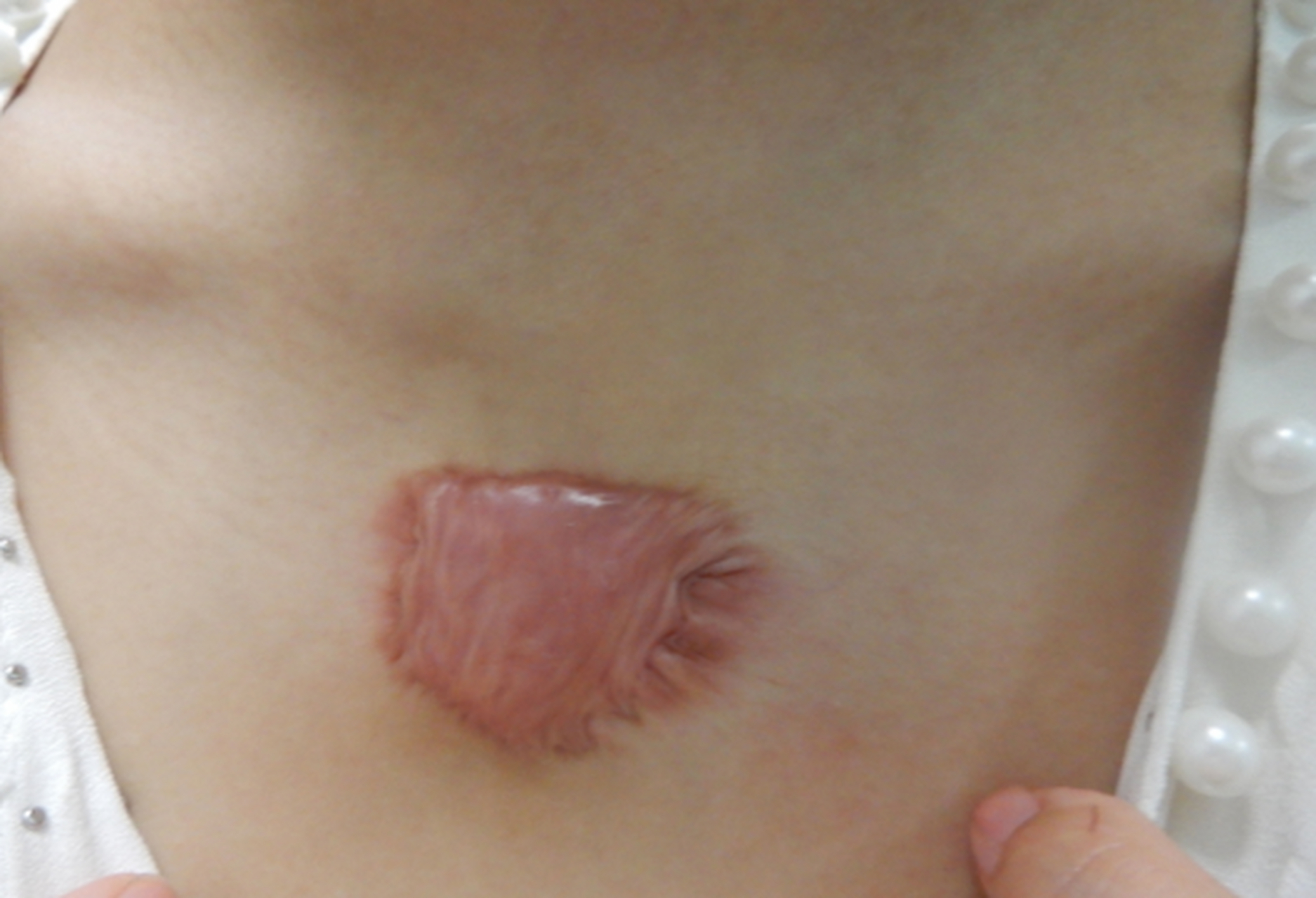 患者后背和胸口都有疤痕疙瘩,三年前毛囊炎导致的,刚开始只是一浮小