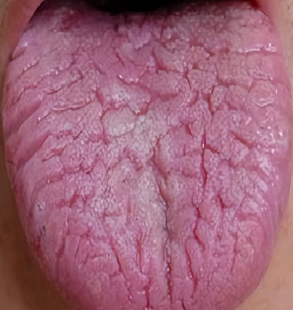 舌下静脉较粗,典型的脾胃湿热夹瘀.