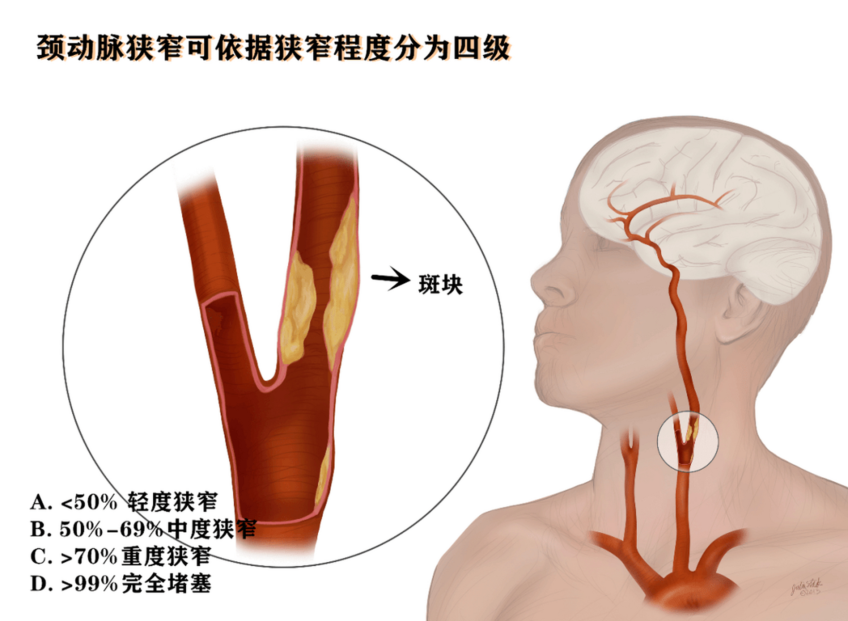 王先生,53岁,颈动脉斑块长是5.