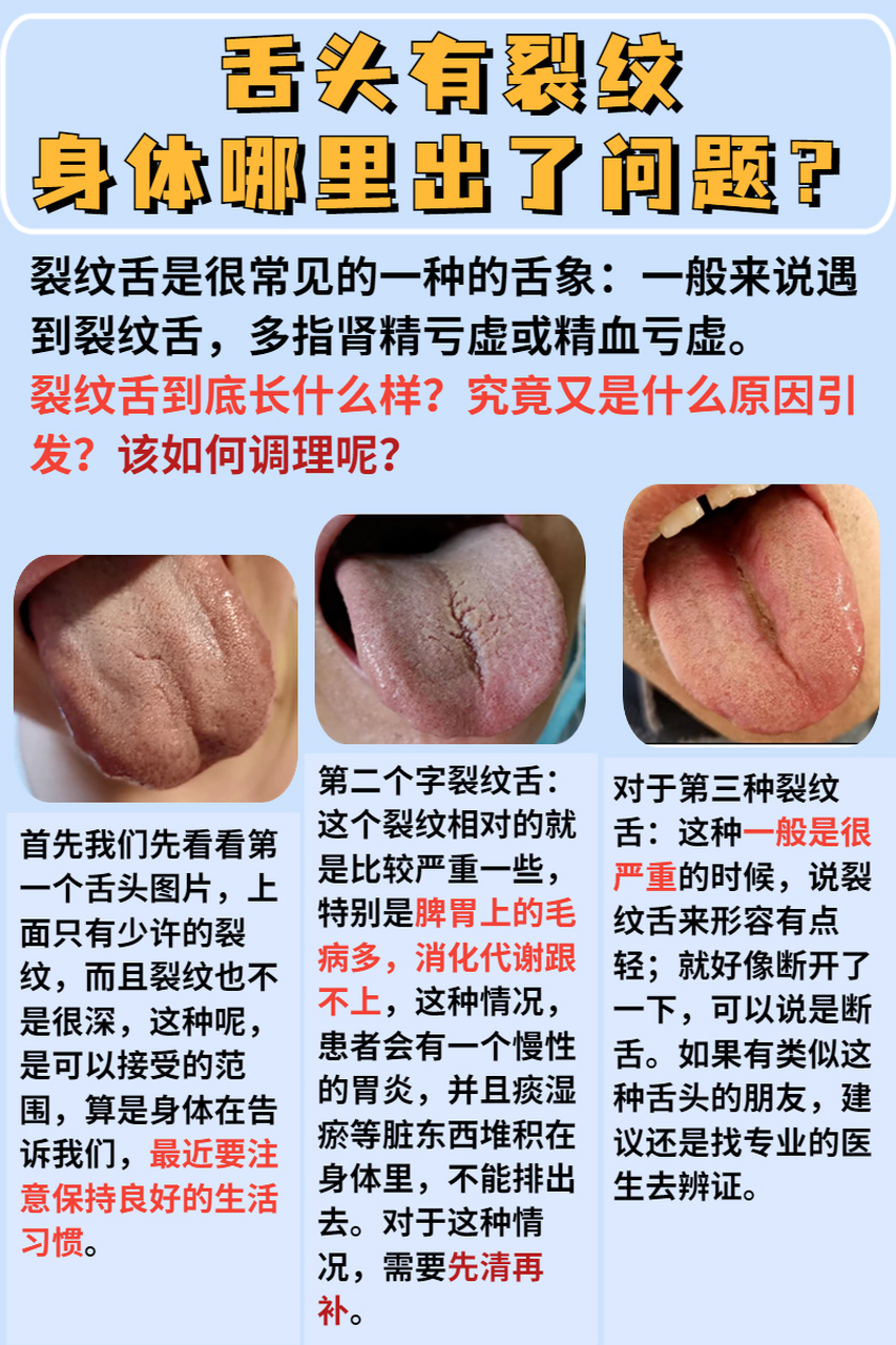 中医说健康 | 舌头有裂纹,身体哪里出了问题?