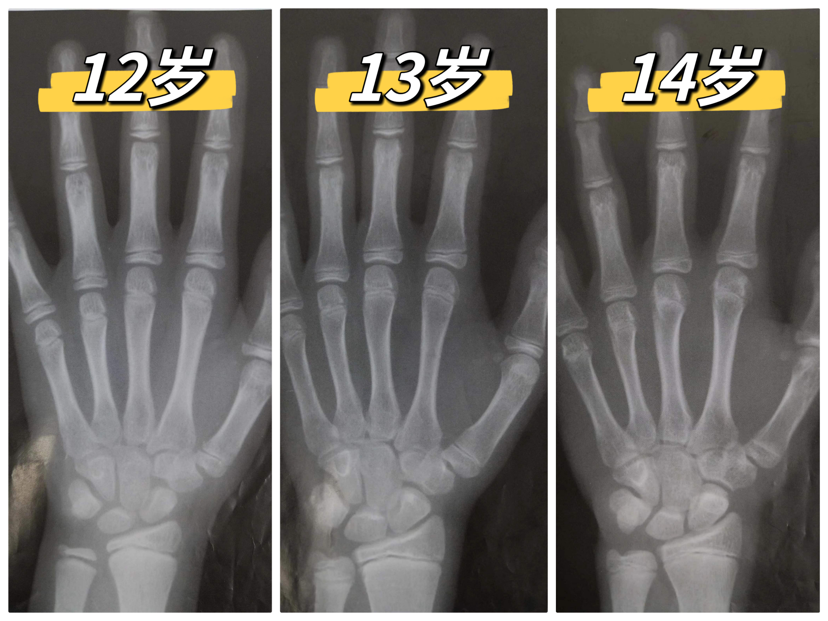 骨龄是孩子的生物年龄,骨龄片主要是看孩子的生长发育情况,骨骺线闭合