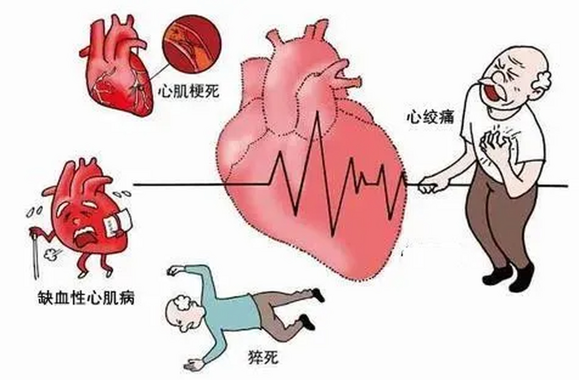 冠心病上门时,身体会有8个症状,做好这几点,或能预防  冠心病是冠状