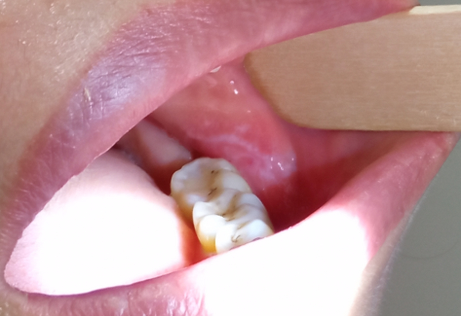 牙龈溃疡发白3年多,以为是发炎了,其实不是.