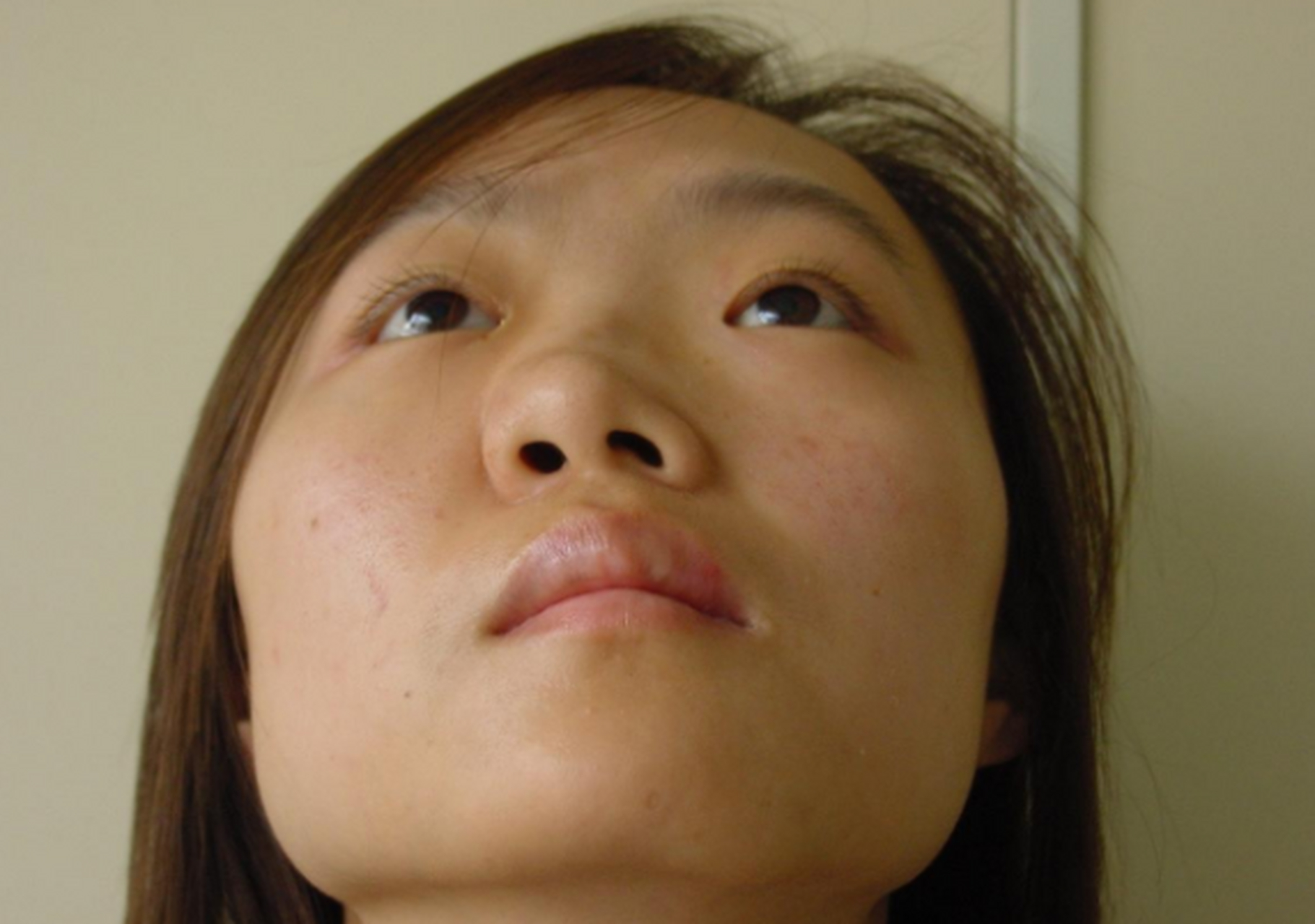 扭曲的很厉害,然后找到我做了手术,大家来看看术后效果如何?