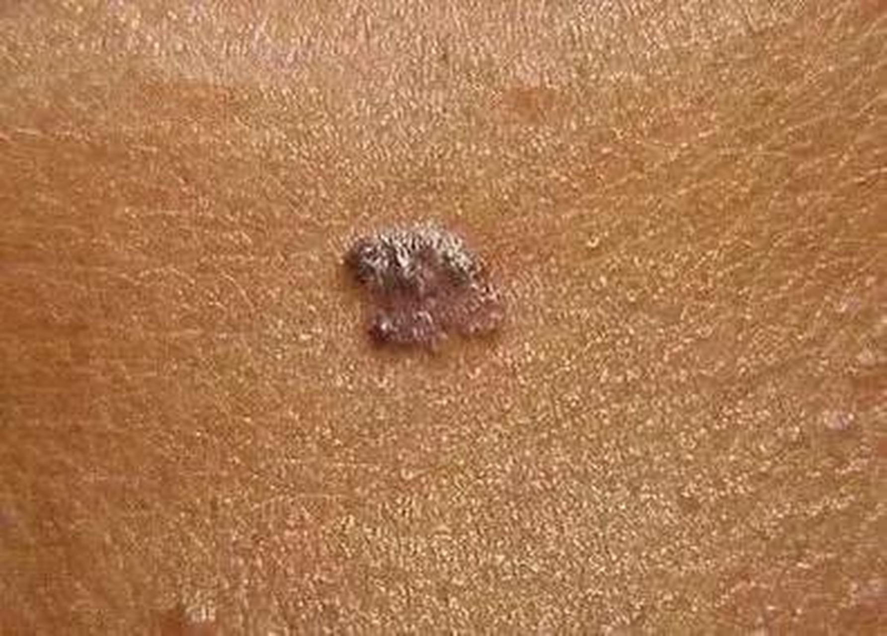 这是因为基底细胞癌虽然在皮肤癌方面的发病率很高,较为常见,但临床