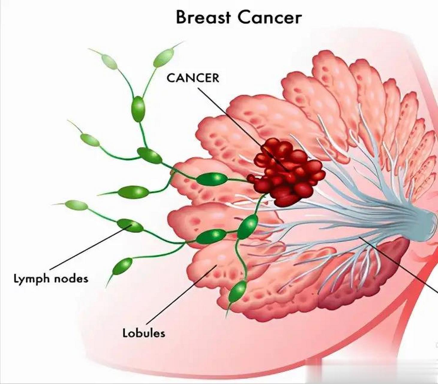 乳腺癌淋巴结肿大图片