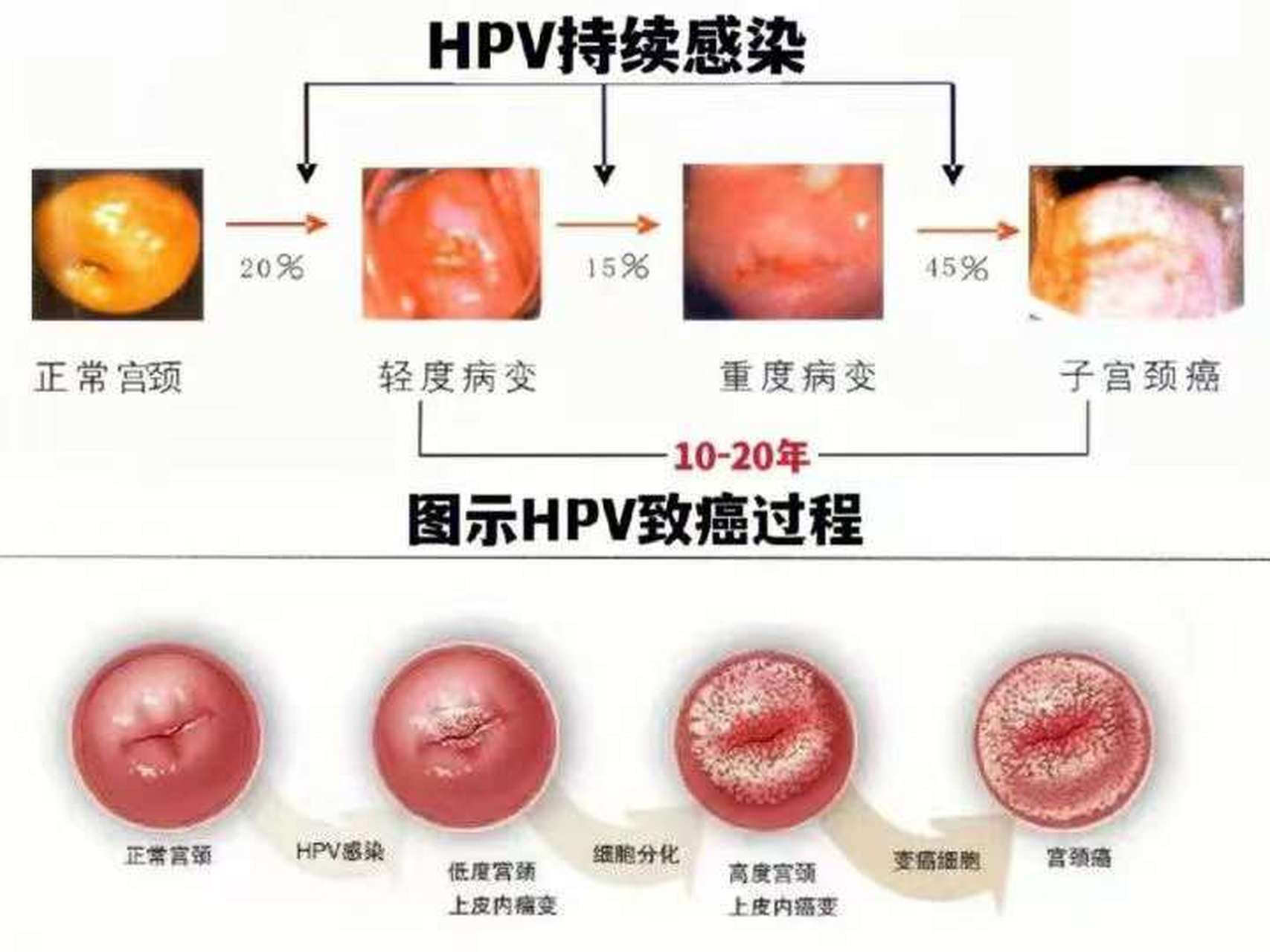 HPV感染癌变图片