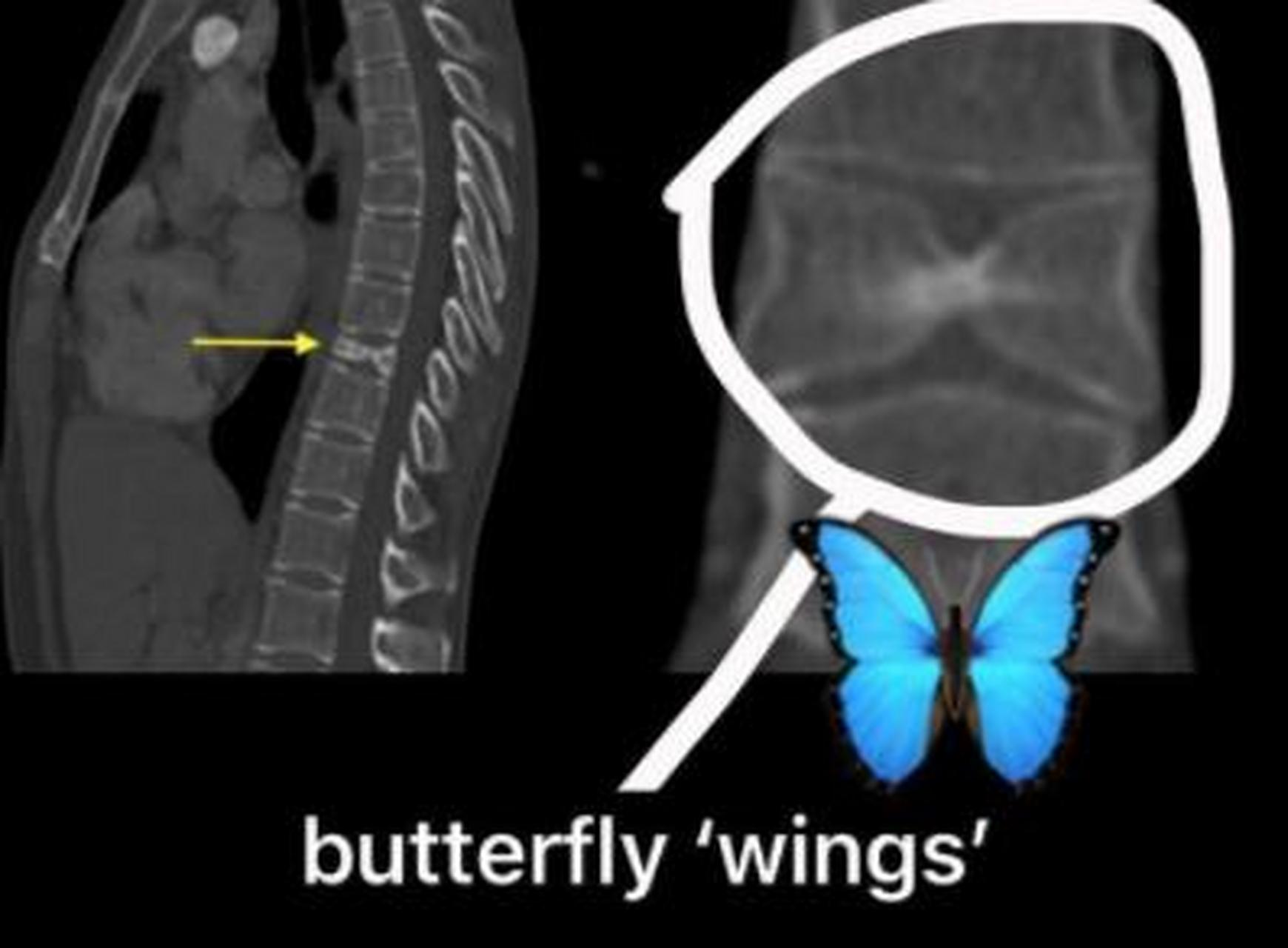 椎体发育异常——蝴蝶椎  蝴蝶椎是一种脊柱椎体畸形,由于椎体的两个