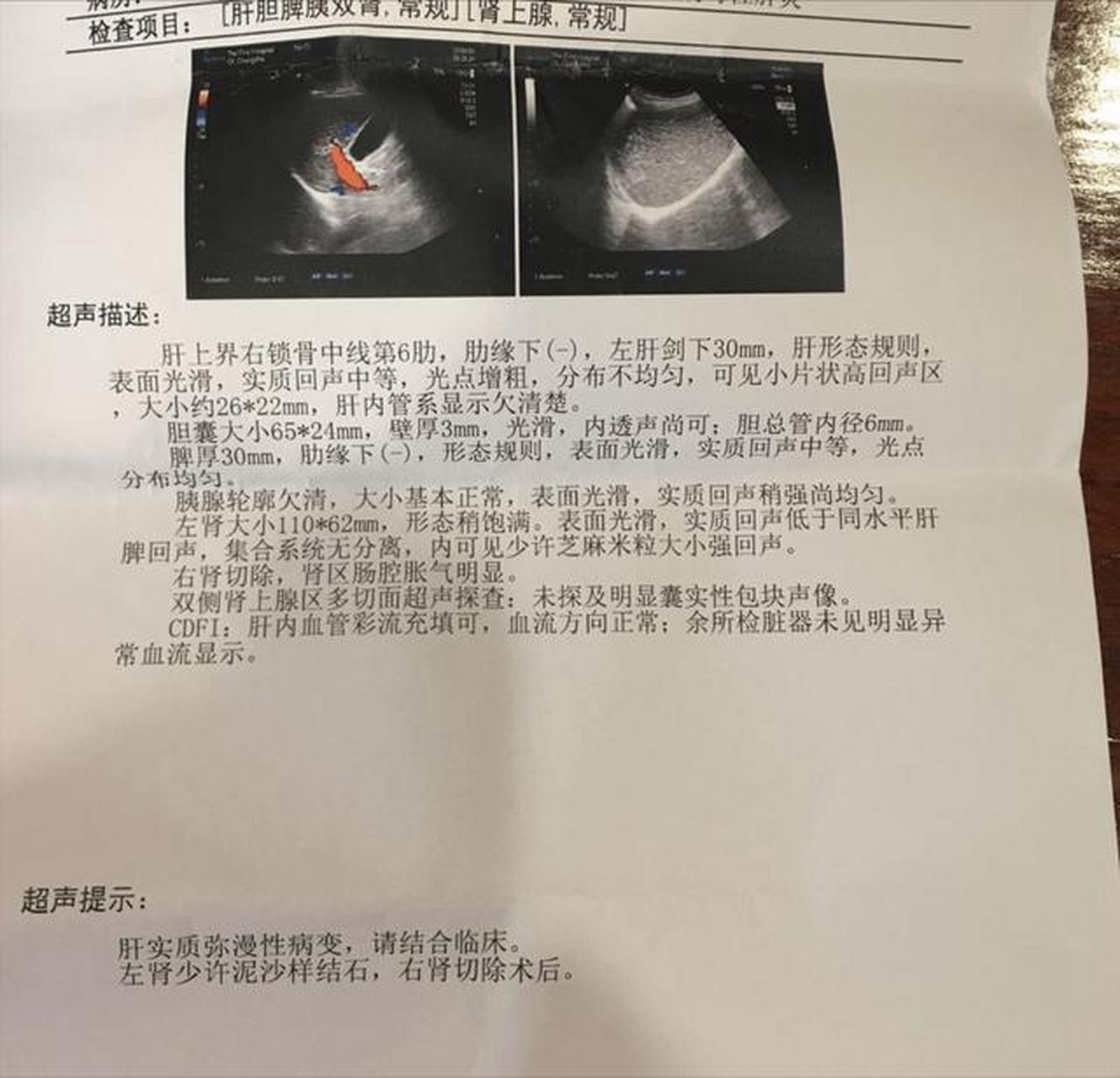 "肝弥漫性病变""肝实质性占位"不一定就是肝硬化,肝癌,还可能是这几种