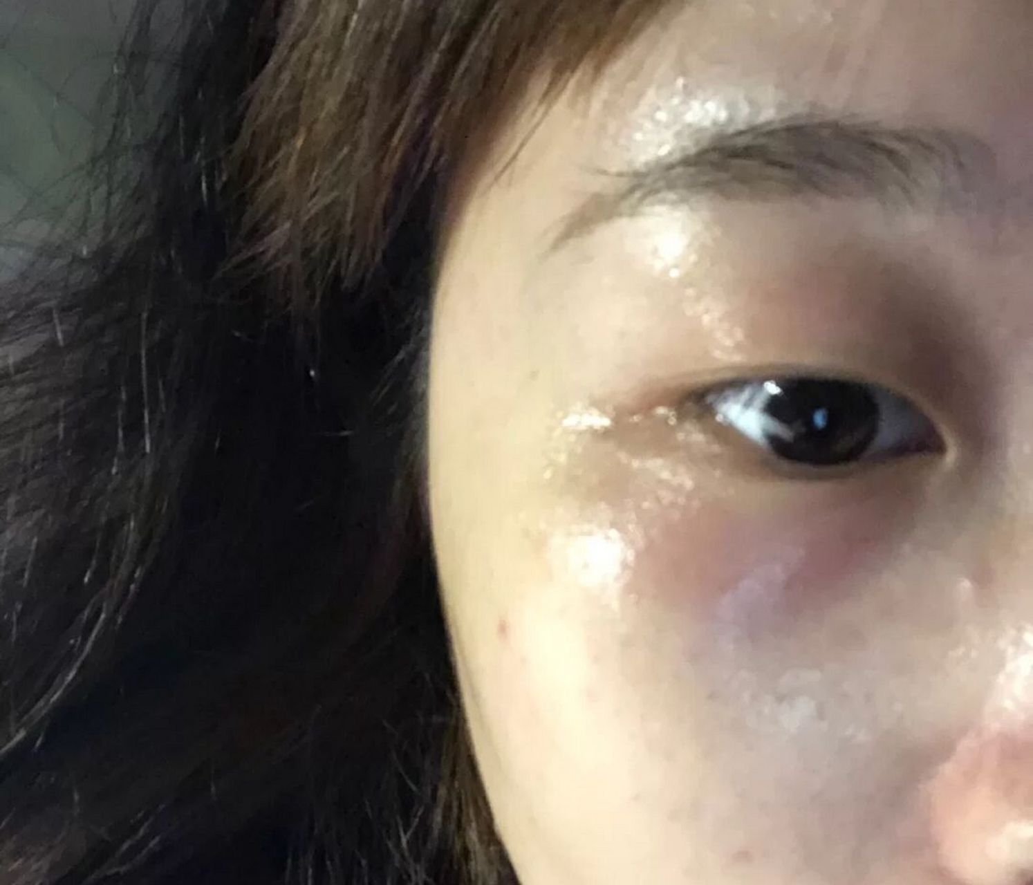 眼部过敏怎么办过了半个月没想到因为吃了一次牛肉 眼部过敏更严重了