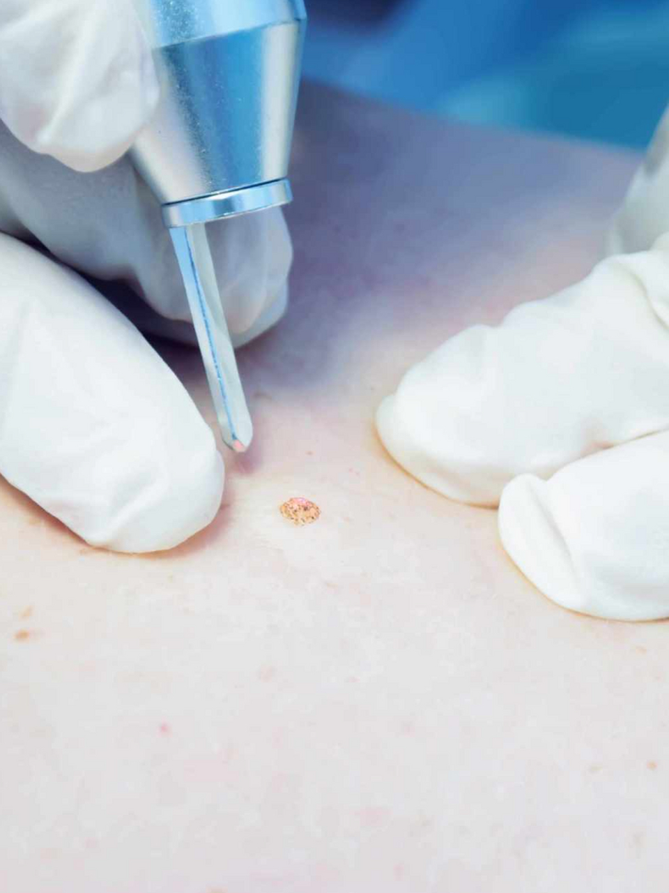 激光点痣# 身上有红色的小红点痣 怎么去掉?