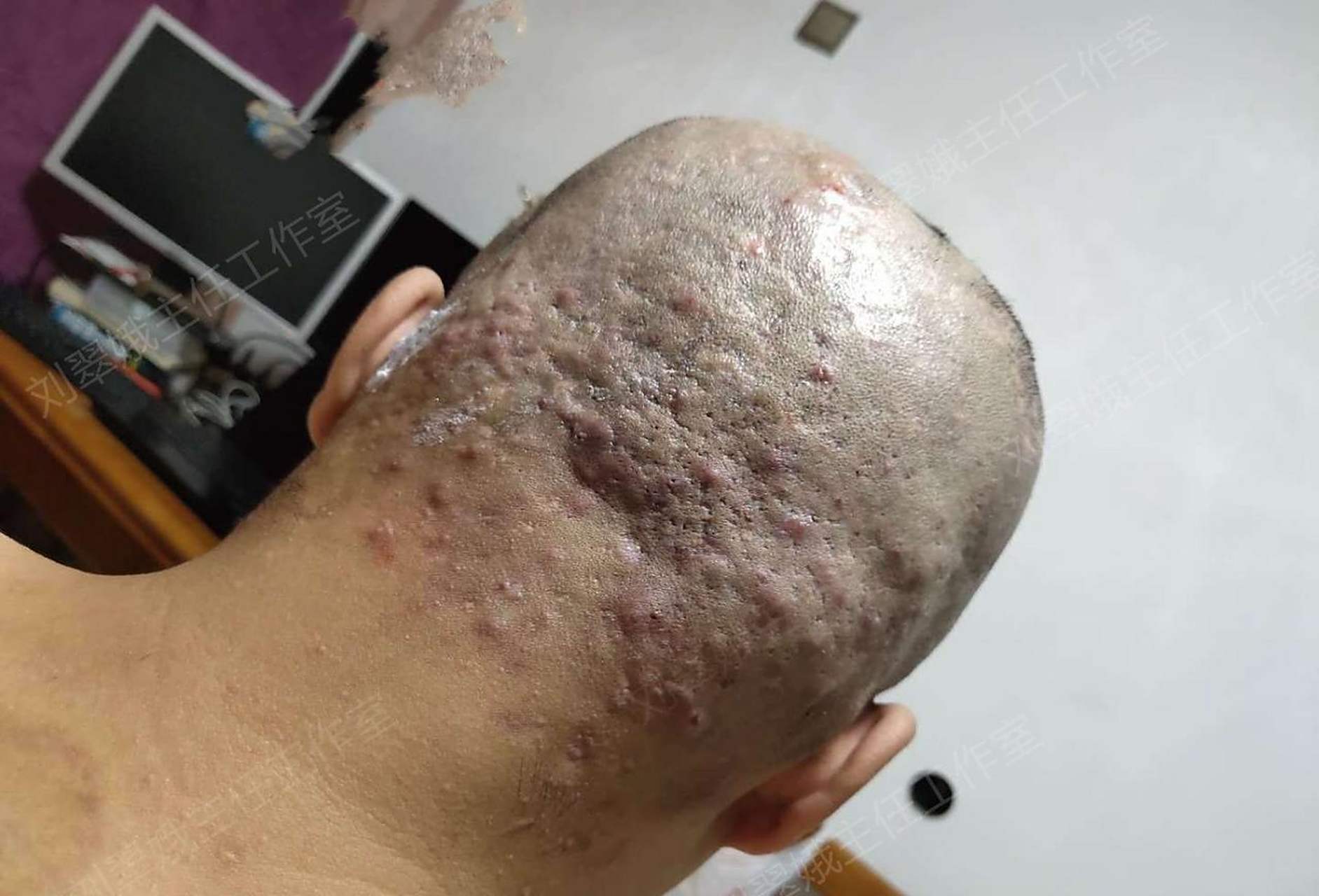 一个27岁的小伙子来看病,他头上长了很多红疙瘩,又疼又痒.