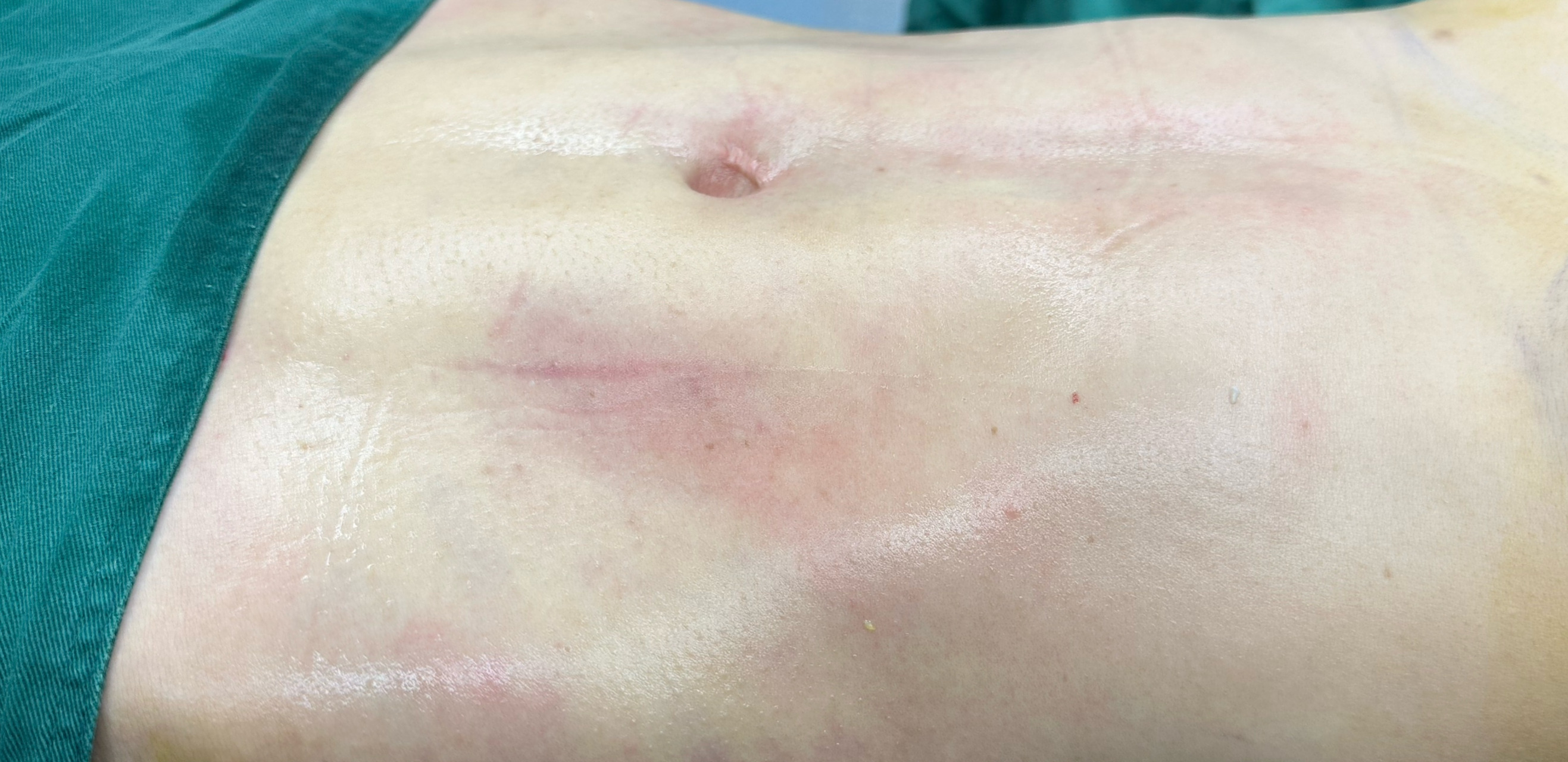 马甲线# #自体脂肪丰胸#   一:手术方式:腰腹吸脂 妈妈臀吸脂 自体