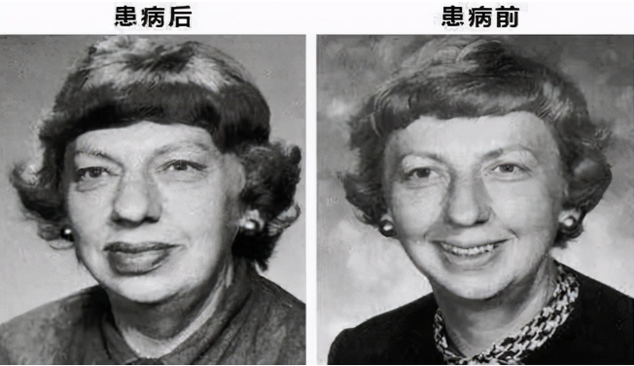 给大家分享一个垂体瘤病例:  患者高某,32岁,女性  主诉:停经泌乳3月