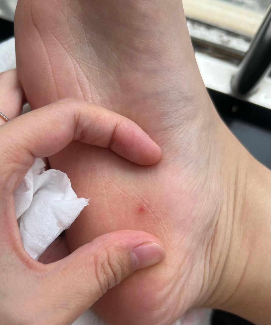 不小心被钉子扎到了,要怎么办?