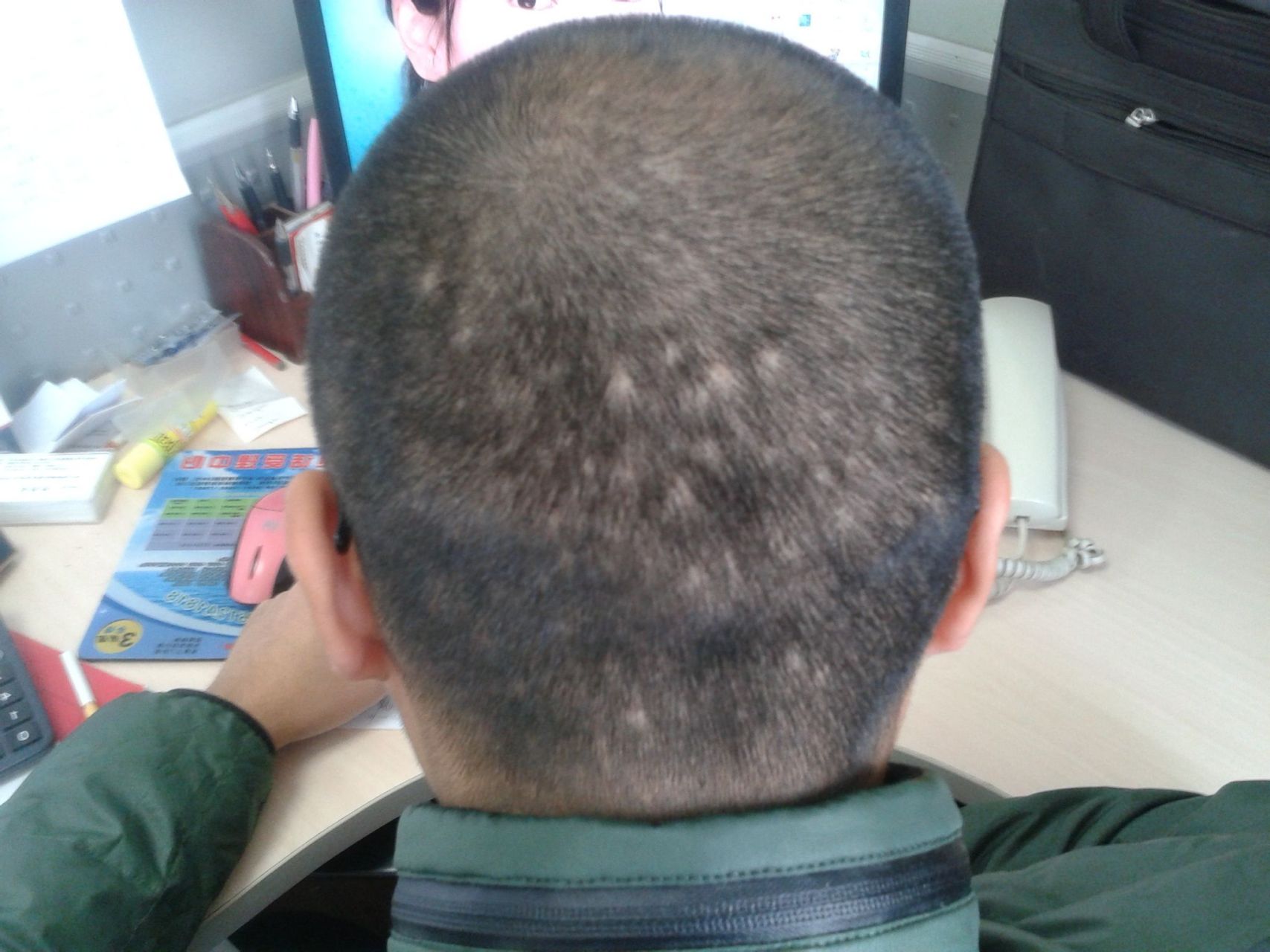 头发秃了一小块怎么治?