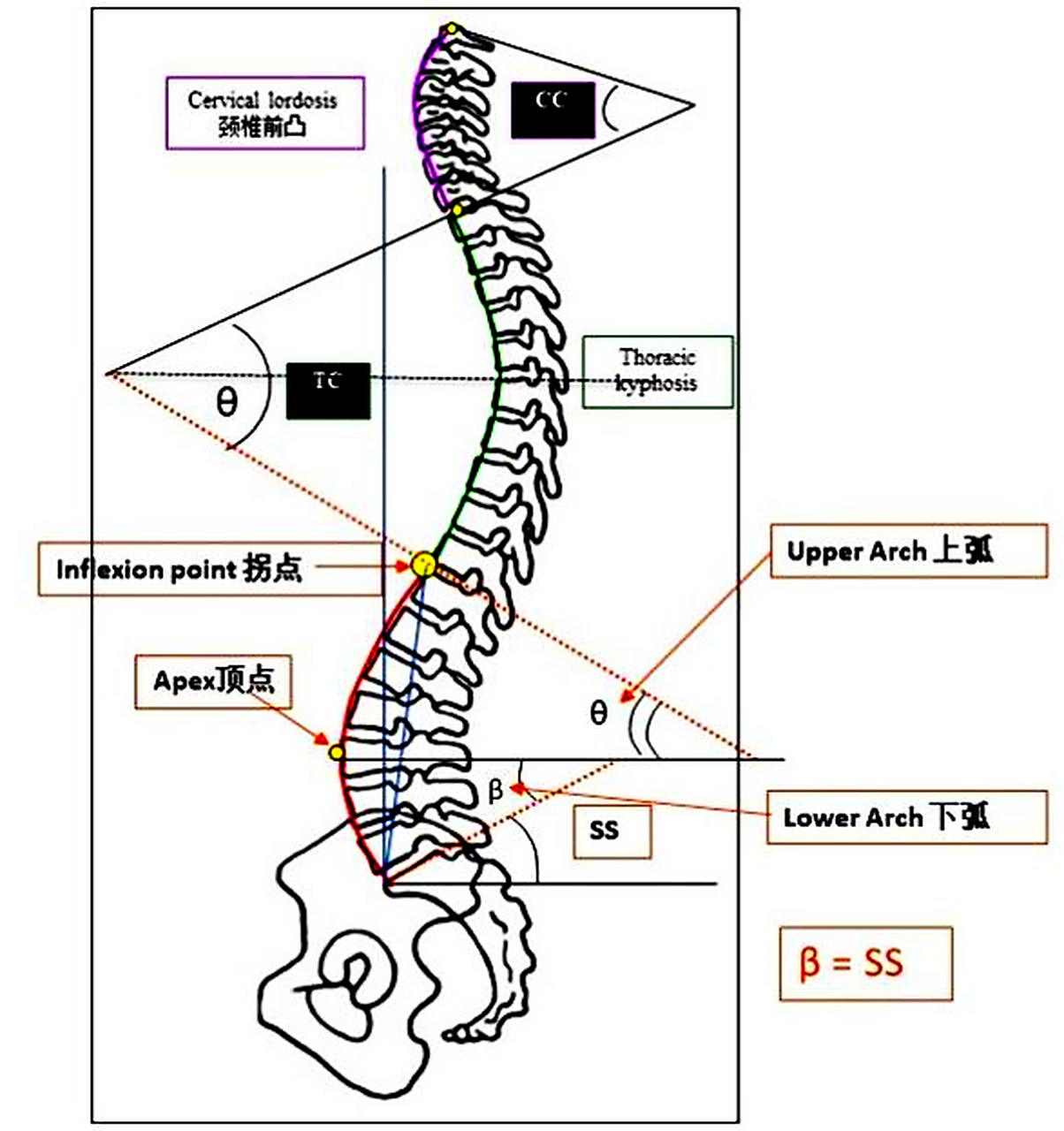 脊柱侧凸 成人脊柱侧凸(adult spinal deformity, asd)是指在冠状面上