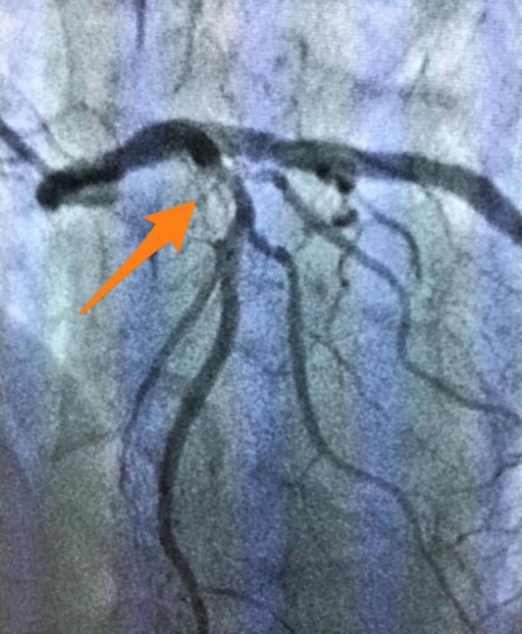 前降支狭窄70%,又不想做支架,中药调理半年血管通畅了 很多血管狭窄的