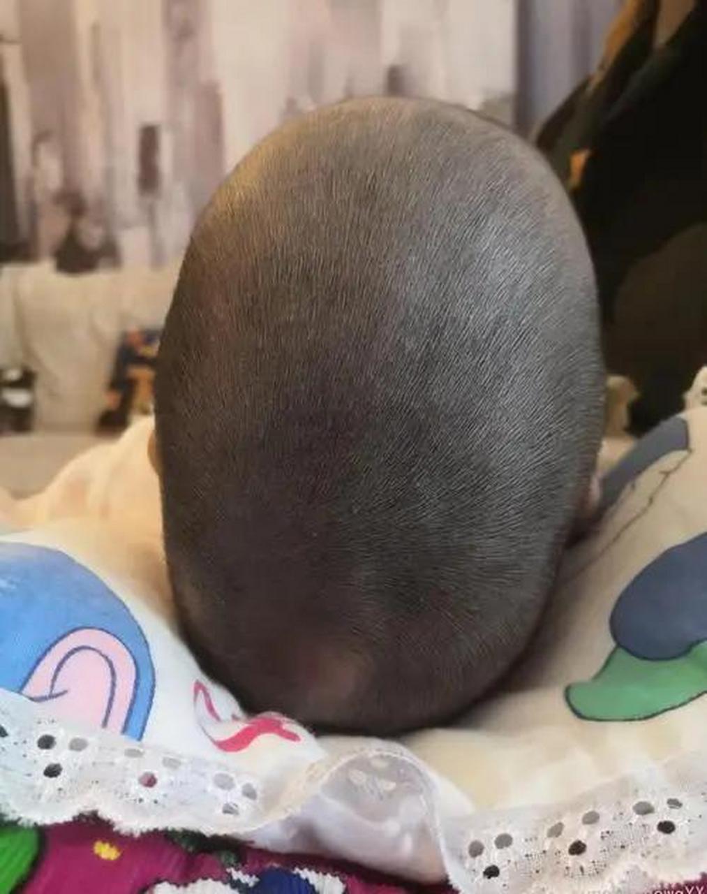 10个月大的婴儿,刚出生时头不是圆的而是尖的,想着是顺产的时候遭到了
