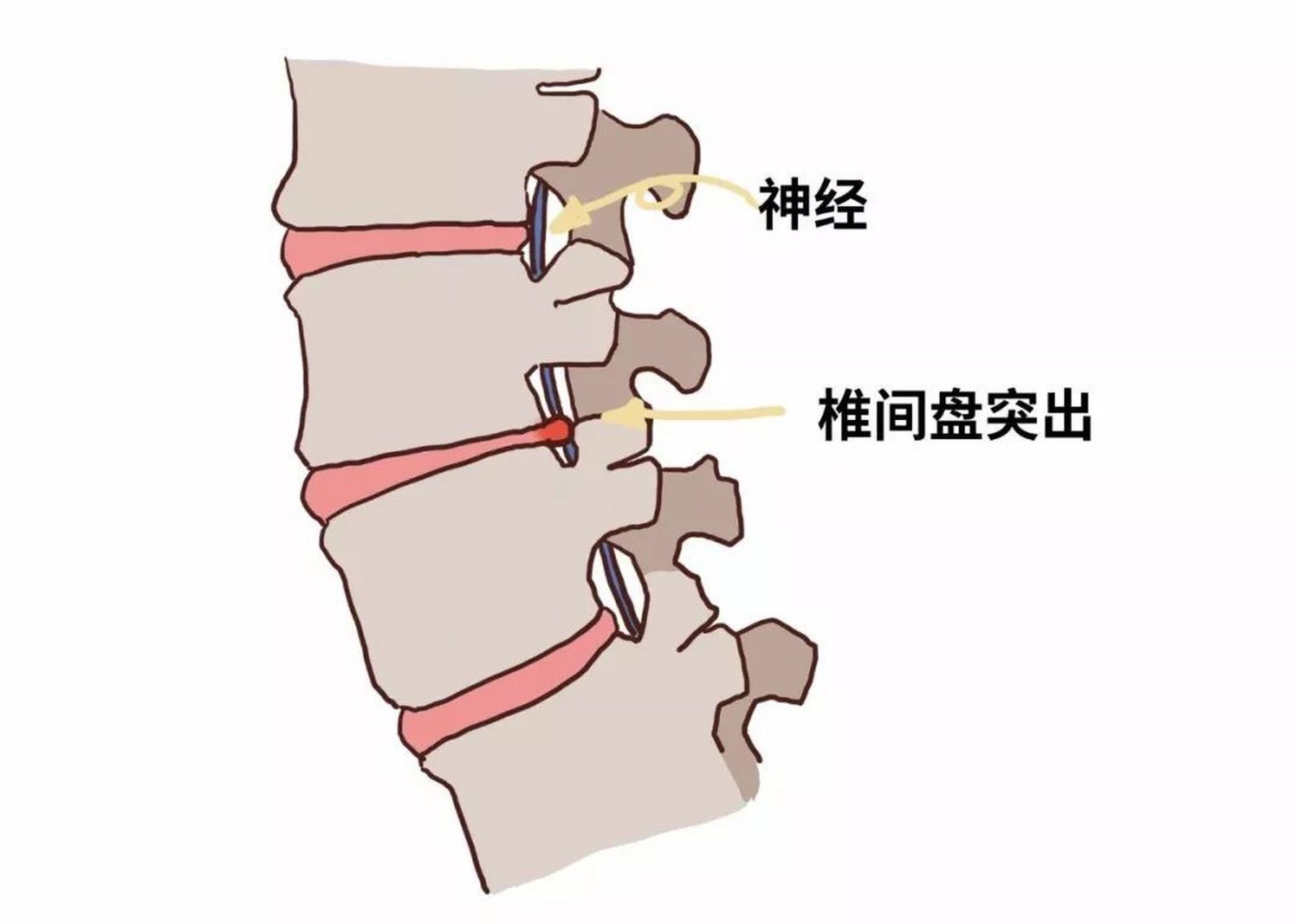 腰间盘压力图图片